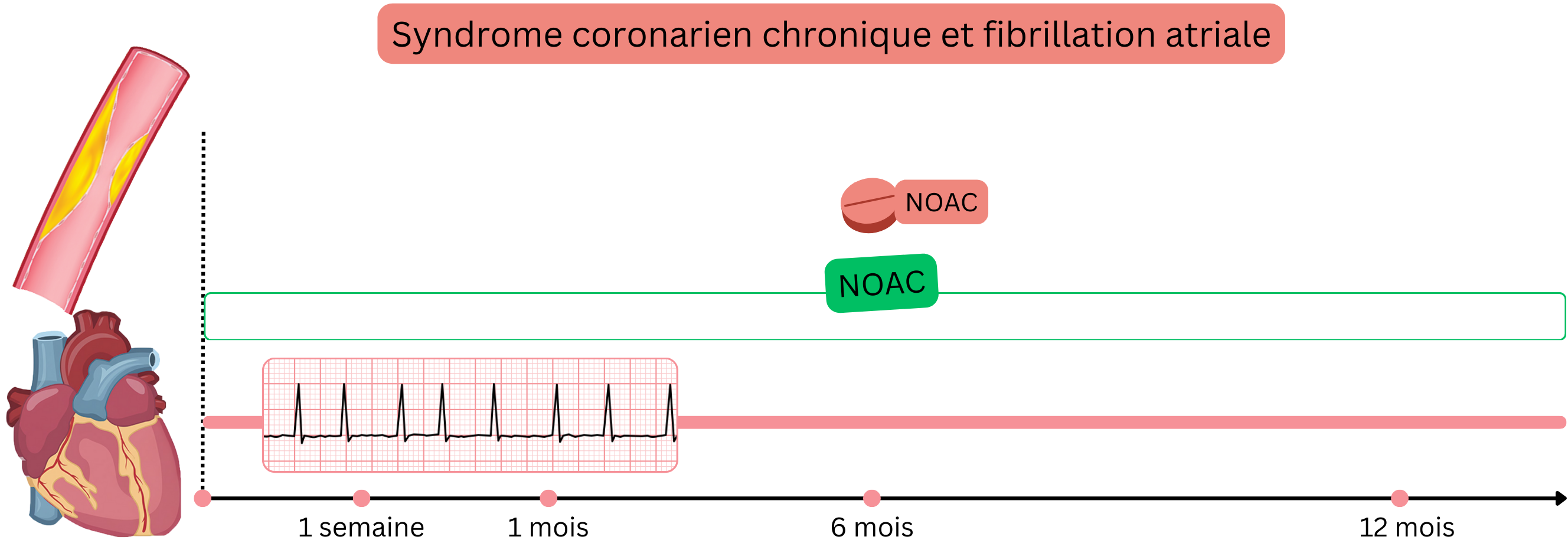 Infographie illustrant le traitement de la fibrillation atriale dans le syndrome coronarien chronique sans ICP récente par une monothérapie prolongée par AOD.