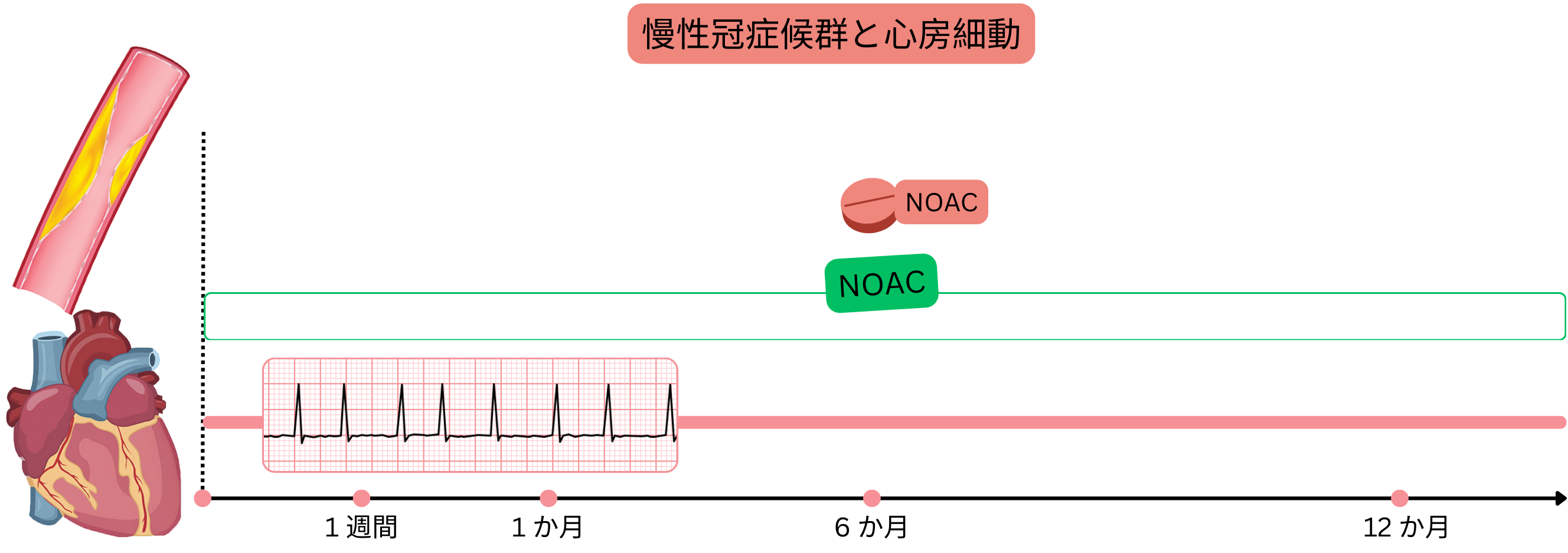 最近のPCIを伴わない慢性冠動脈症候群における心房細動の治療として、長期NOAC単剤療法を示すインフォグラフィック。
