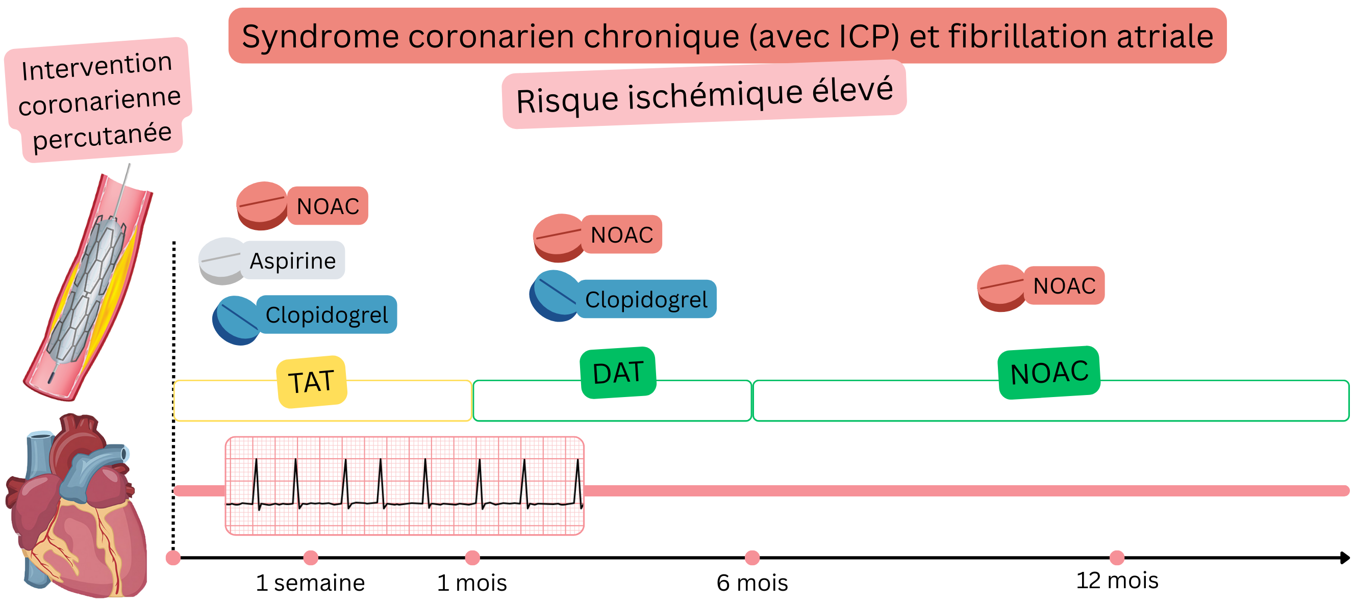 Infographie illustrant la stratégie de traitement antithrombotique chez les patients atteints de syndrome coronarien chronique après ICP et fibrillation atriale à haut risque ischémique, avec une TAT initiale suivie d’une DAT puis d’une monothérapie par AOD.