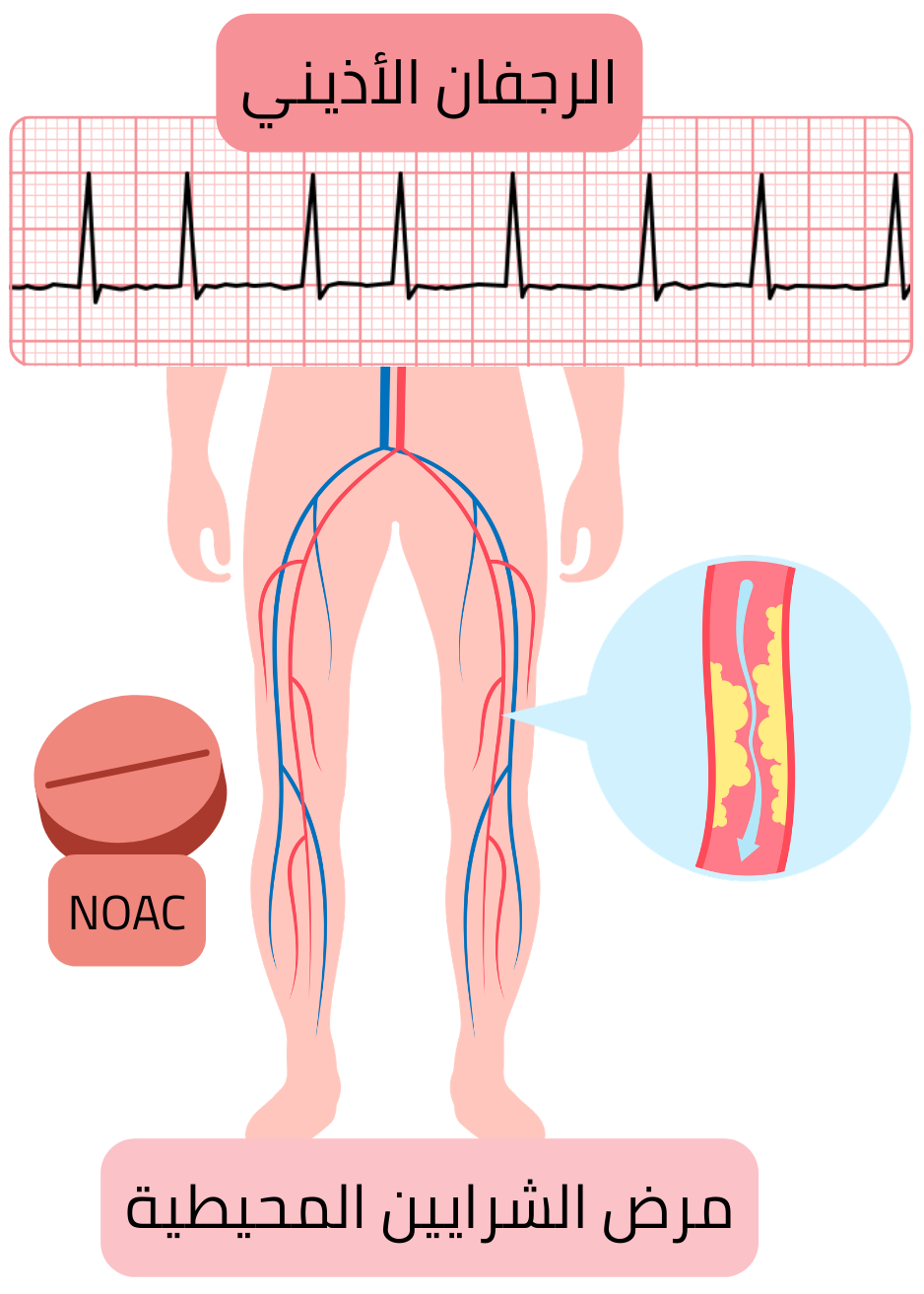رسم توضيحي يُظهر الرجفان الأذيني مع مرض الشرايين المحيطية في الأطراف السفلية، وتصلب الشرايين، مع وجود استطباب للعلاج المضاد للتخثر باستخدام مضادات التخثر الفموية الحديثة.