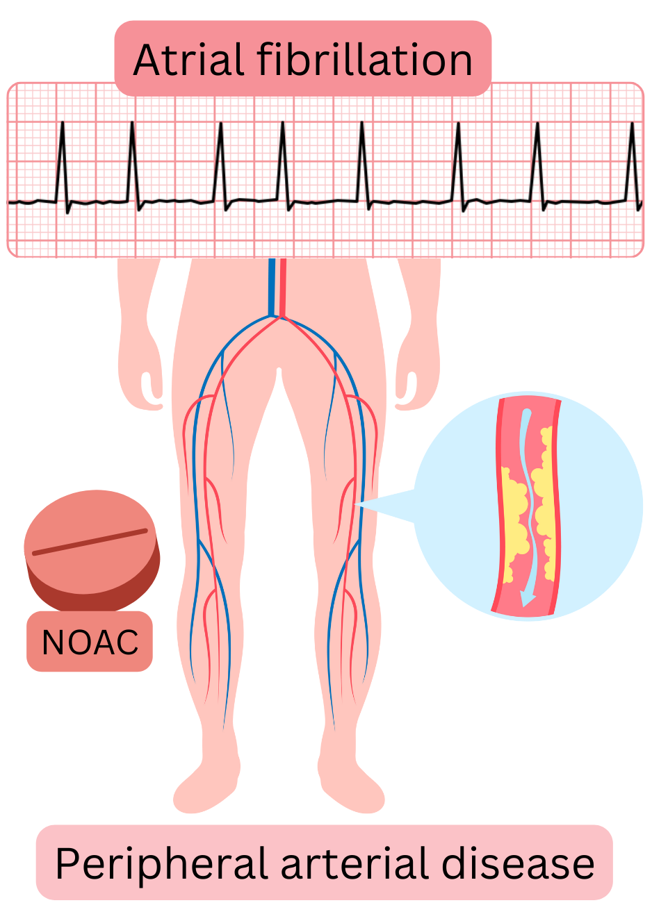 Illustration depicting atrial fibrillation with peripheral arterial disease of the lower limbs, atherosclerotic arterial involvement, and indication for anticoagulation with NOACs.