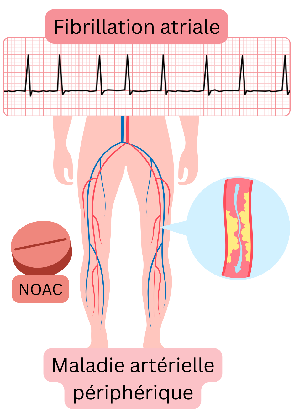 Illustration montrant une fibrillation atriale associée à une artériopathie périphérique des membres inférieurs, une atteinte athéroscléreuse des artères et une indication d’anticoagulation par AOD.