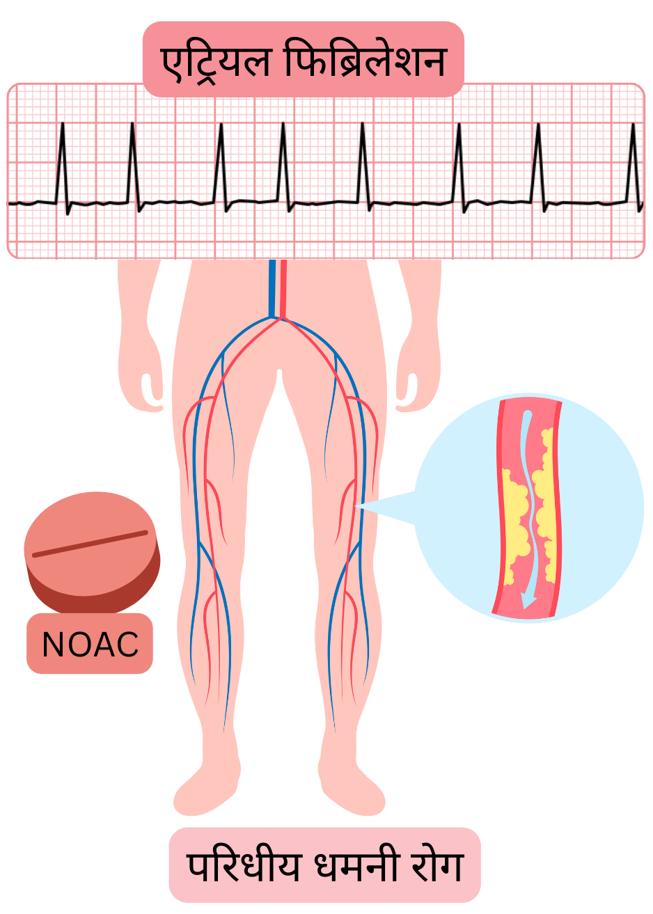 यह चित्र एट्रियल फिब्रिलेशन के साथ निचले अंगों की परिधीय धमनी रोग, धमनियों की एथेरोस्क्लेरोटिक भागीदारी तथा NOAC से एंटीकॉगुलेंट उपचार की संकेतना को दर्शाता है।