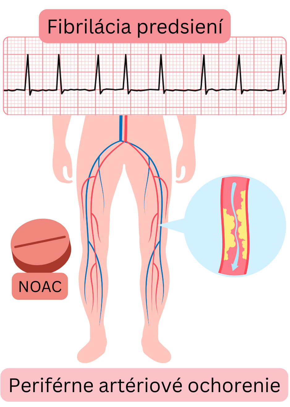 Ilustrácia znázorňujúca fibriláciu predsiení s periférnym artériovým ochorením dolných končatín, aterosklerotickým postihnutím artérií a indikáciou antikoagulačnej liečby NOAC.