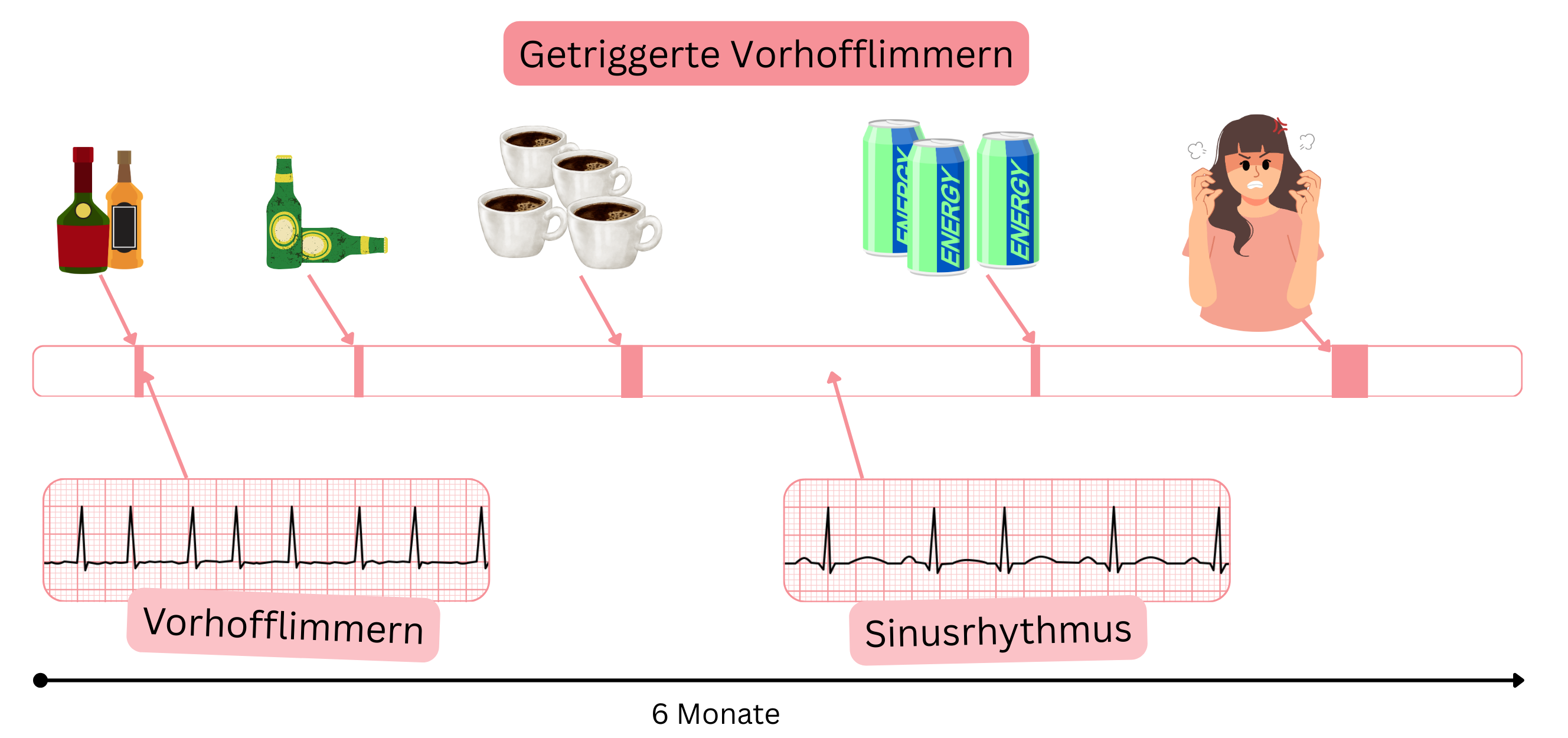 Infografik zur Darstellung einer durch Alkohol, Koffein, Energy-Drinks und emotionalen Stress ausgelösten getriggerten Vorhofflimmerns mit zeitlichen Übergängen zwischen Vorhofflimmern und Sinusrhythmus.