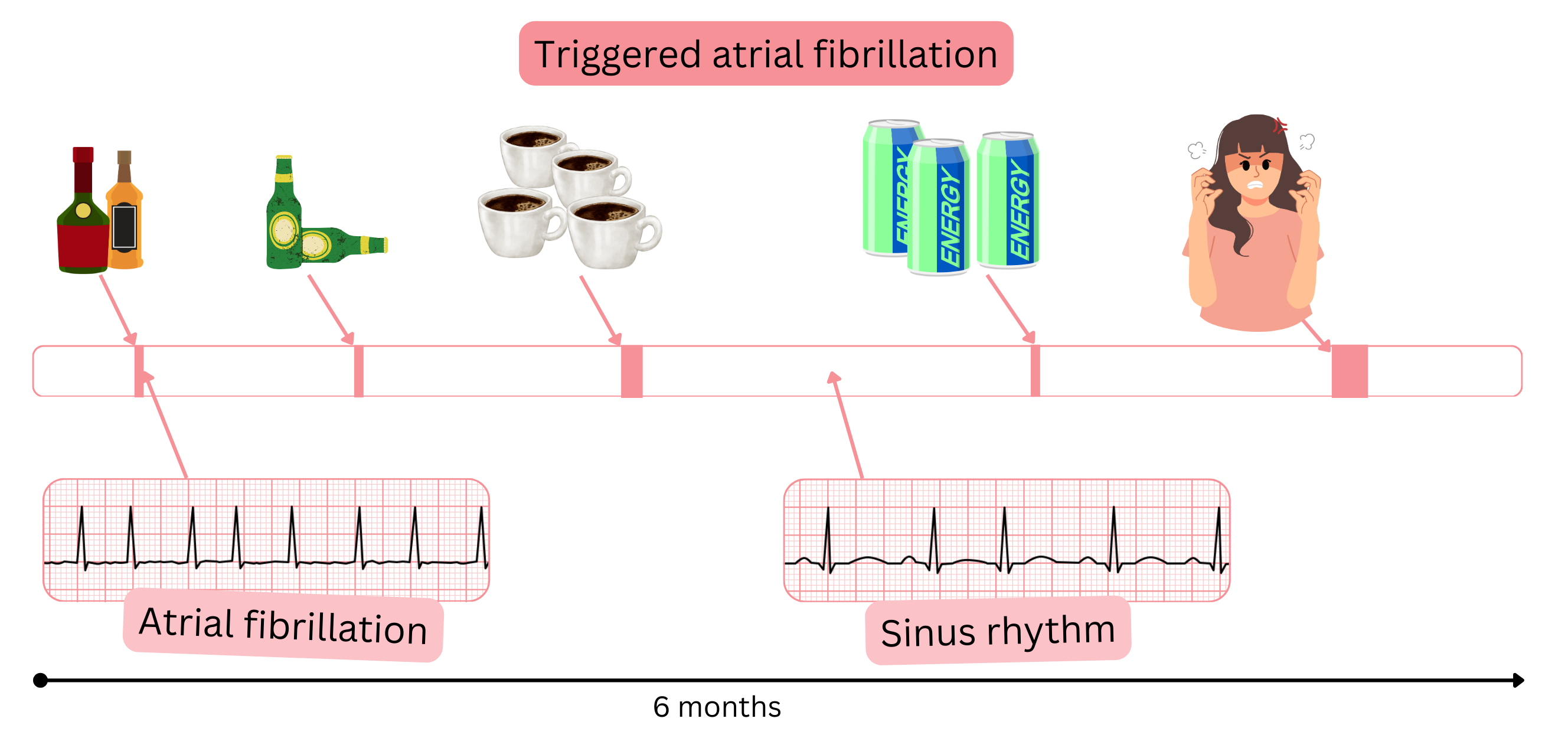 Infographic illustrating trigger-induced atrial fibrillation caused by alcohol, caffeine, energy drinks, and emotional stress, with transitions between atrial fibrillation and sinus rhythm over time.