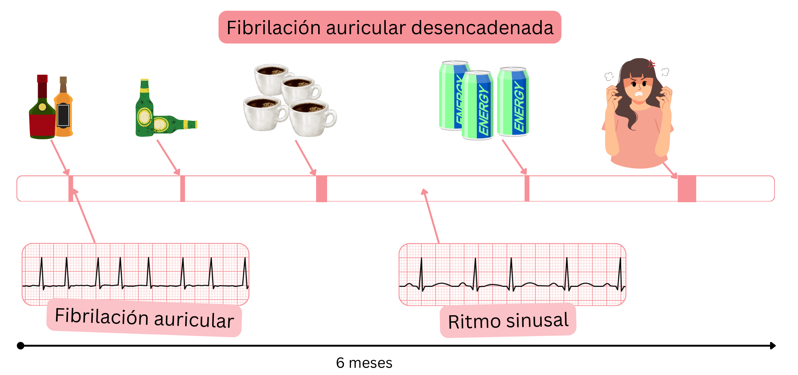Infografía que muestra la fibrilación auricular inducida por desencadenantes como alcohol, cafeína, bebidas energéticas y estrés emocional, con transiciones entre fibrilación auricular y ritmo sinusal a lo largo del tiempo.