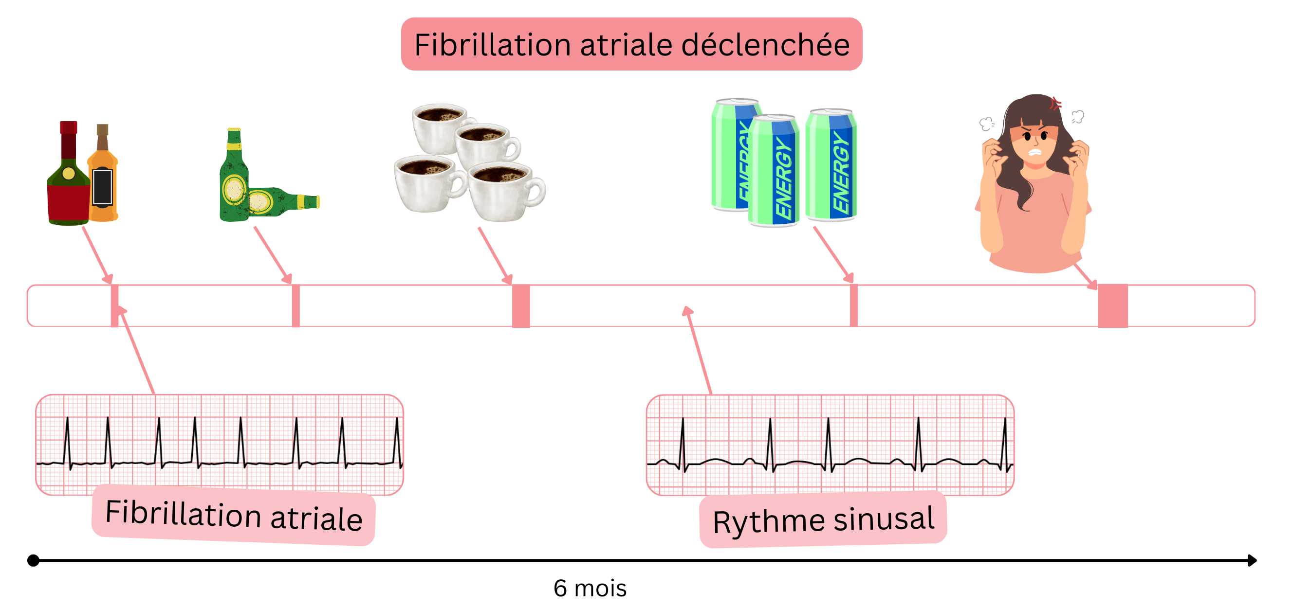 Infographie illustrant une fibrillation atriale déclenchée par l’alcool, la caféine, les boissons énergisantes et le stress émotionnel, avec des transitions entre fibrillation atriale et rythme sinusal au fil du temps.