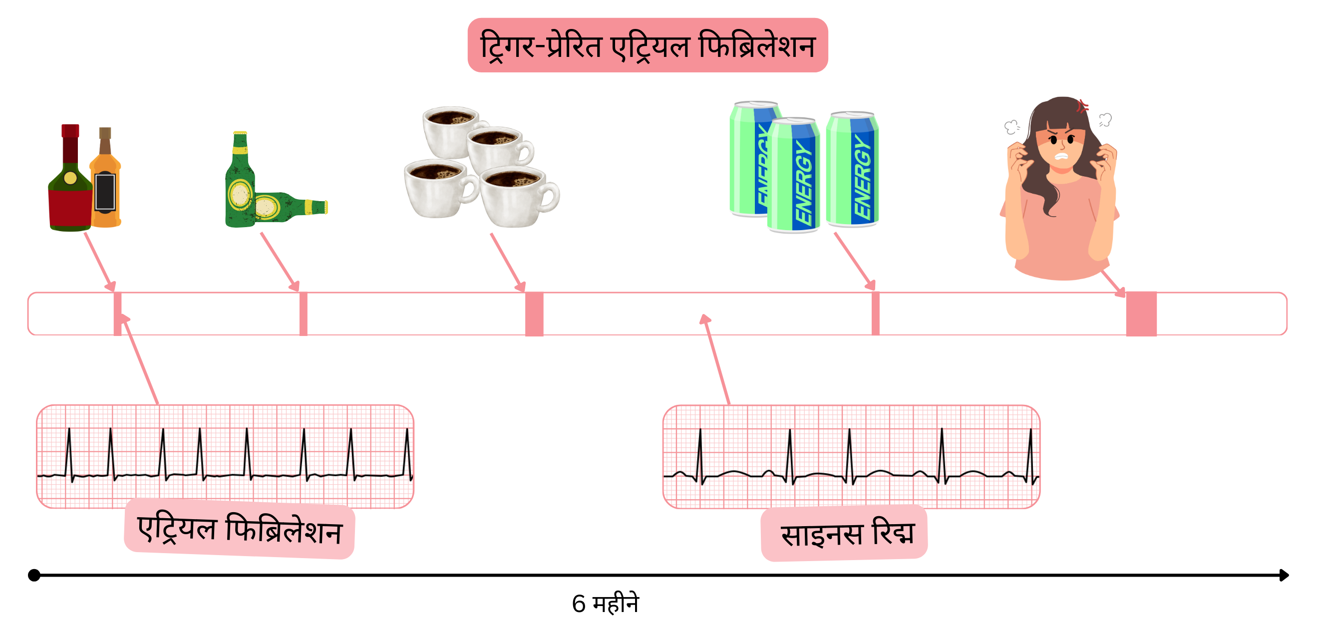 यह इन्फोग्राफिक शराब, कैफीन, एनर्जी ड्रिंक और भावनात्मक तनाव से प्रेरित ट्रिगर-जनित एट्रियल फिब्रिलेशन को दर्शाता है, जिसमें समय के साथ एट्रियल फिब्रिलेशन और साइनस रिद्म के बीच परिवर्तन दिखाया गया है।