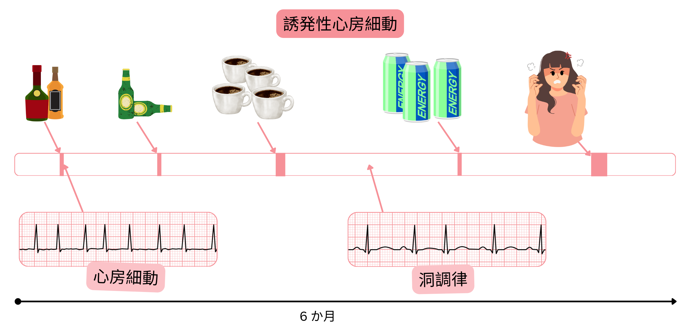 アルコール、カフェイン、エナジードリンク、情動ストレスにより誘発される心房細動と、時間経過に伴う心房細動と洞調律の移行を示すインフォグラフィック。