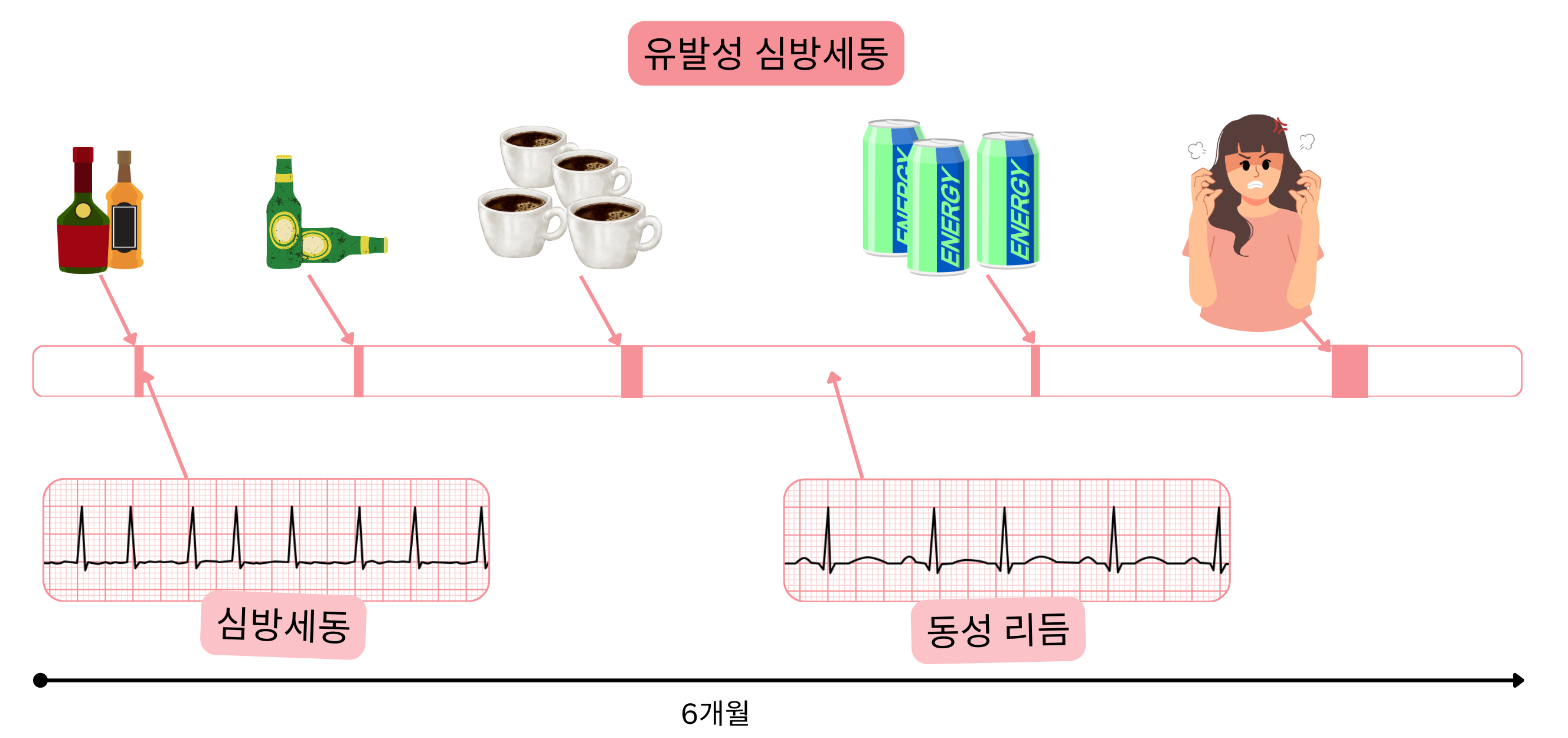 알코올, 카페인, 에너지 음료 및 정서적 스트레스에 의해 유발되는 심방세동과 시간에 따른 심방세동과 동율동 간 전환을 보여주는 인포그래픽.