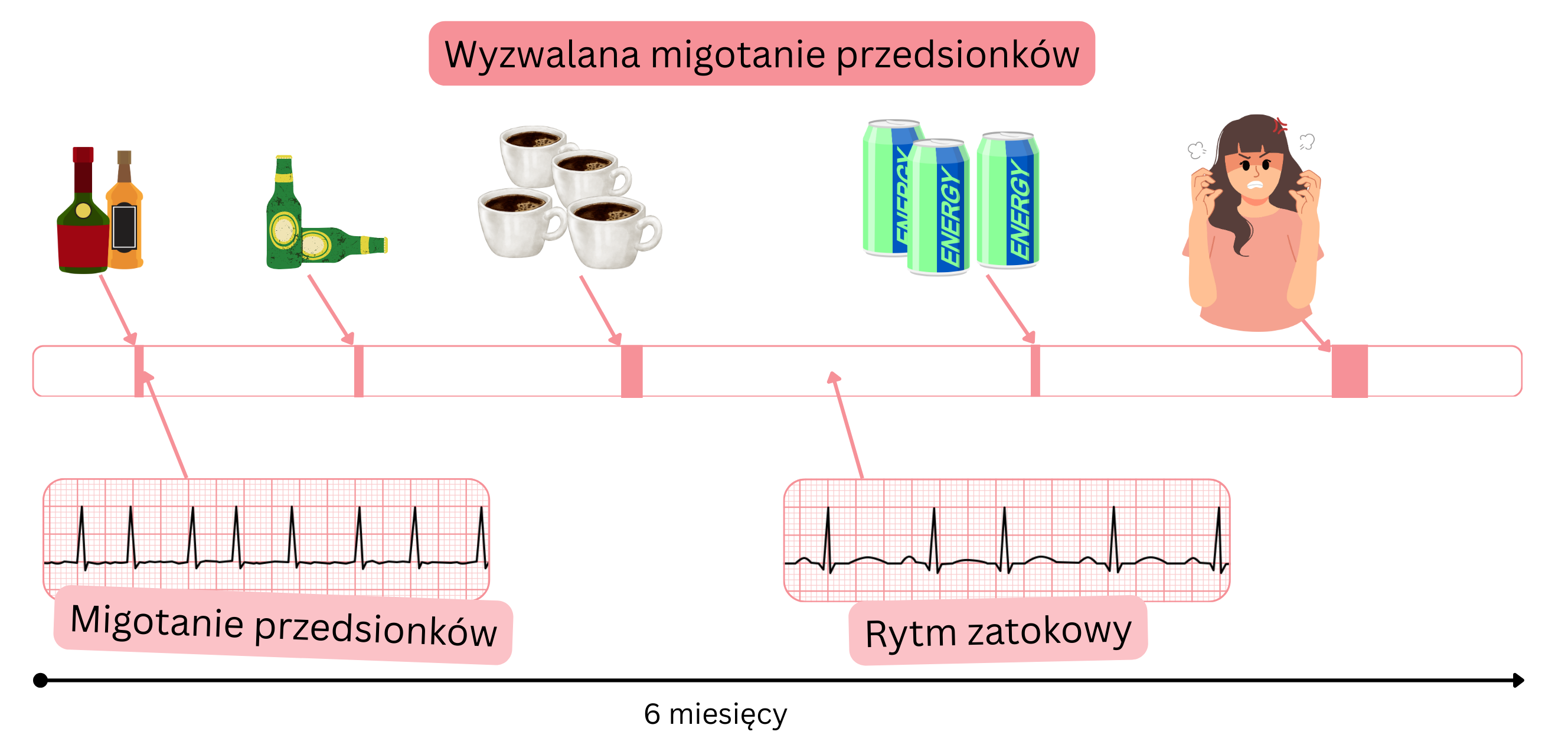 Infografika przedstawiająca migotanie przedsionków wywołane przez alkohol, kofeinę, napoje energetyczne i stres emocjonalny, z przejściami między migotaniem przedsionków a rytmem zatokowym w czasie.
