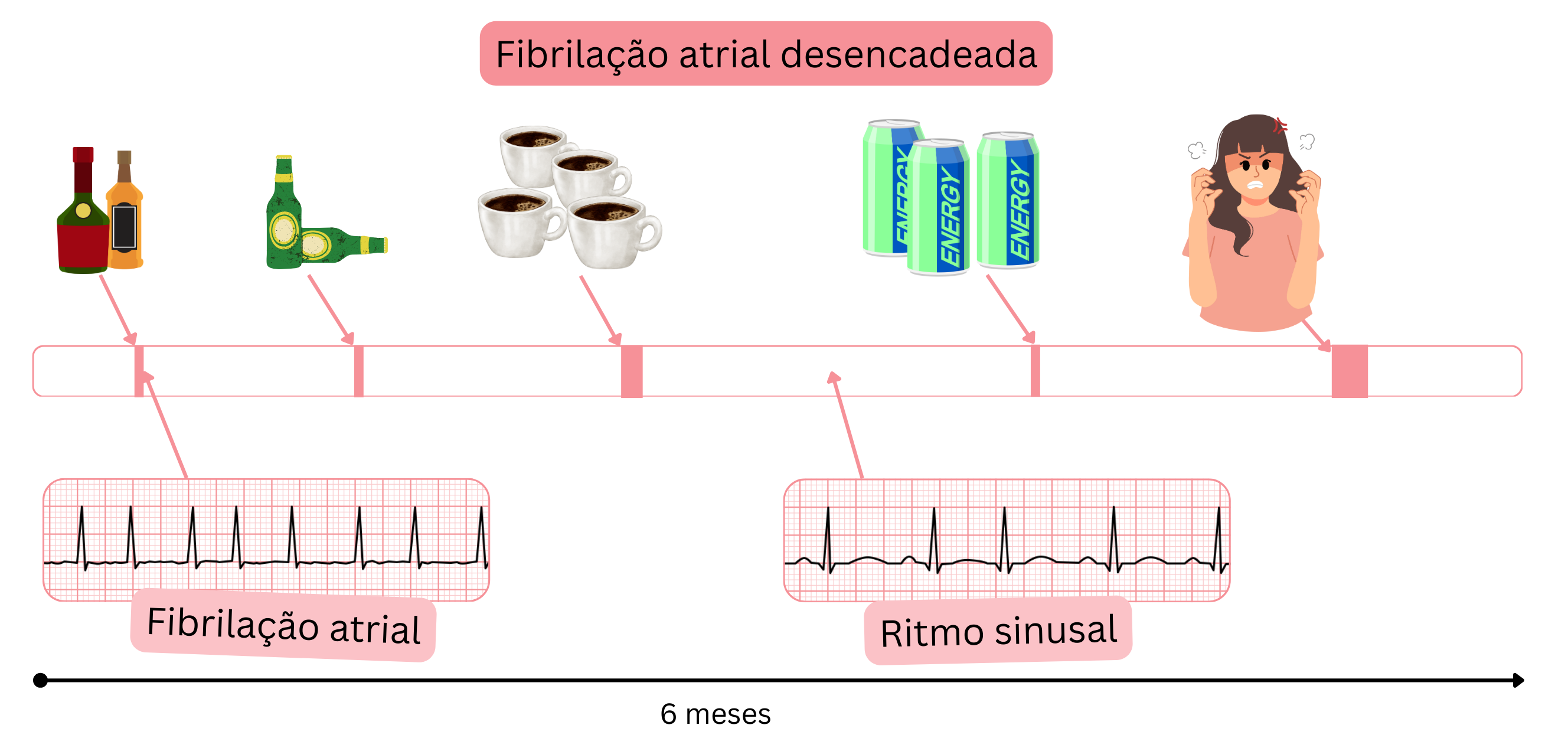 Infográfico que ilustra a fibrilação atrial desencadeada por álcool, cafeína, bebidas energéticas e estresse emocional, com transições entre fibrilação atrial e ritmo sinusal ao longo do tempo.