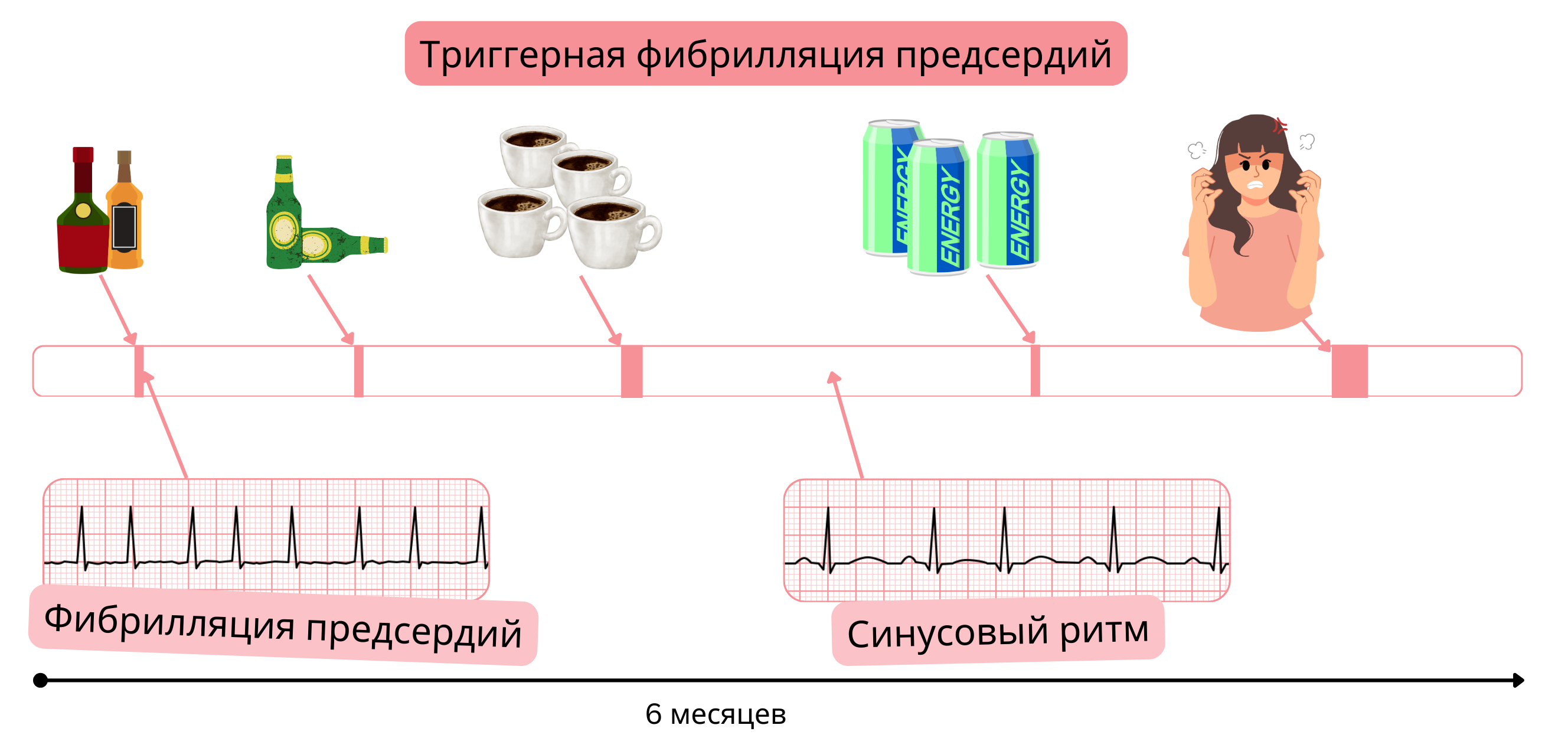 Инфографика, демонстрирующая триггерную фибрилляцию предсердий, вызванную алкоголем, кофеином, энергетическими напитками и эмоциональным стрессом, с переходами между фибрилляцией предсердий и синусовым ритмом во времени.