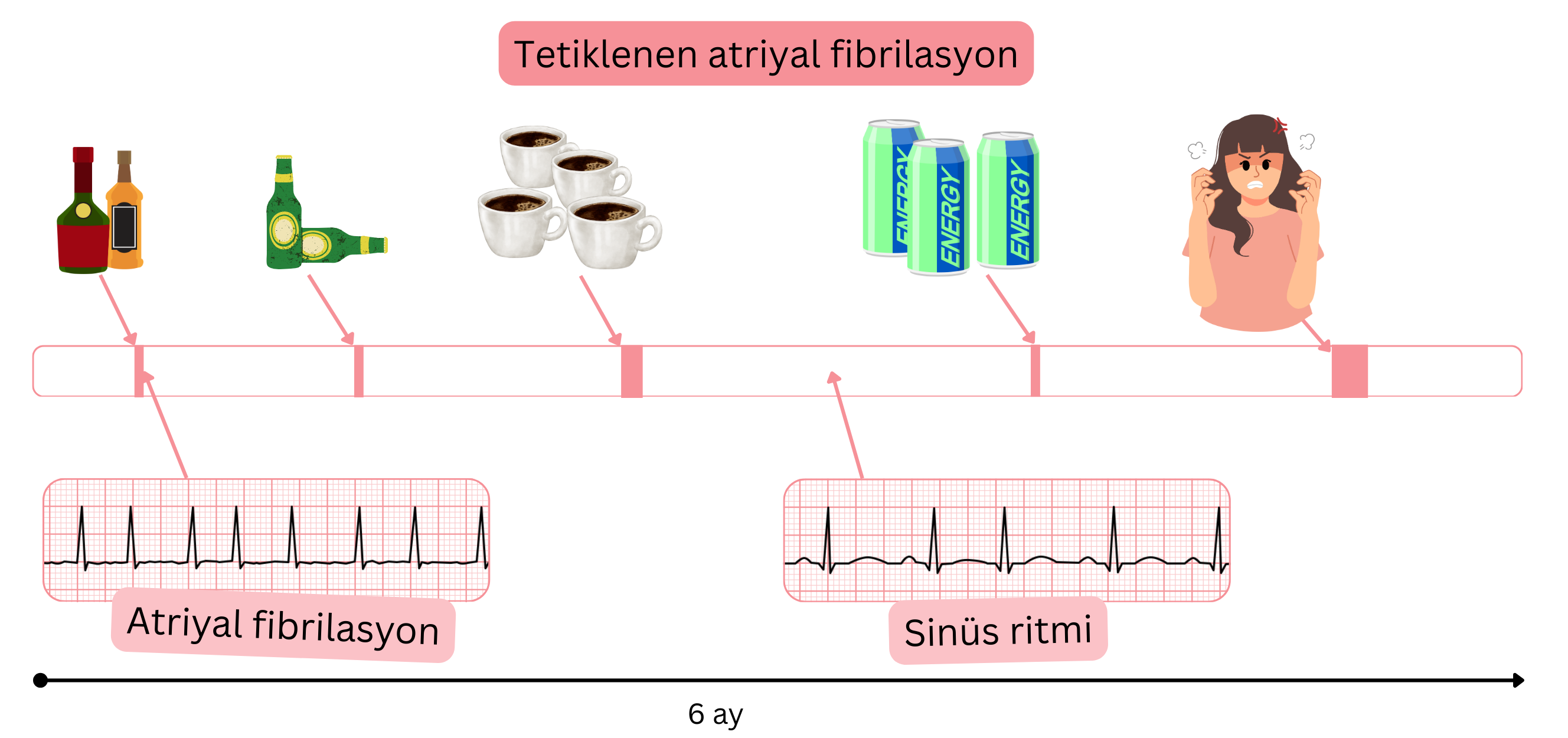 Alkol, kafein, enerji içecekleri ve duygusal stresle tetiklenen atriyal fibrilasyonu ve zaman içinde atriyal fibrilasyon ile sinüs ritmi arasındaki geçişleri gösteren infografik.