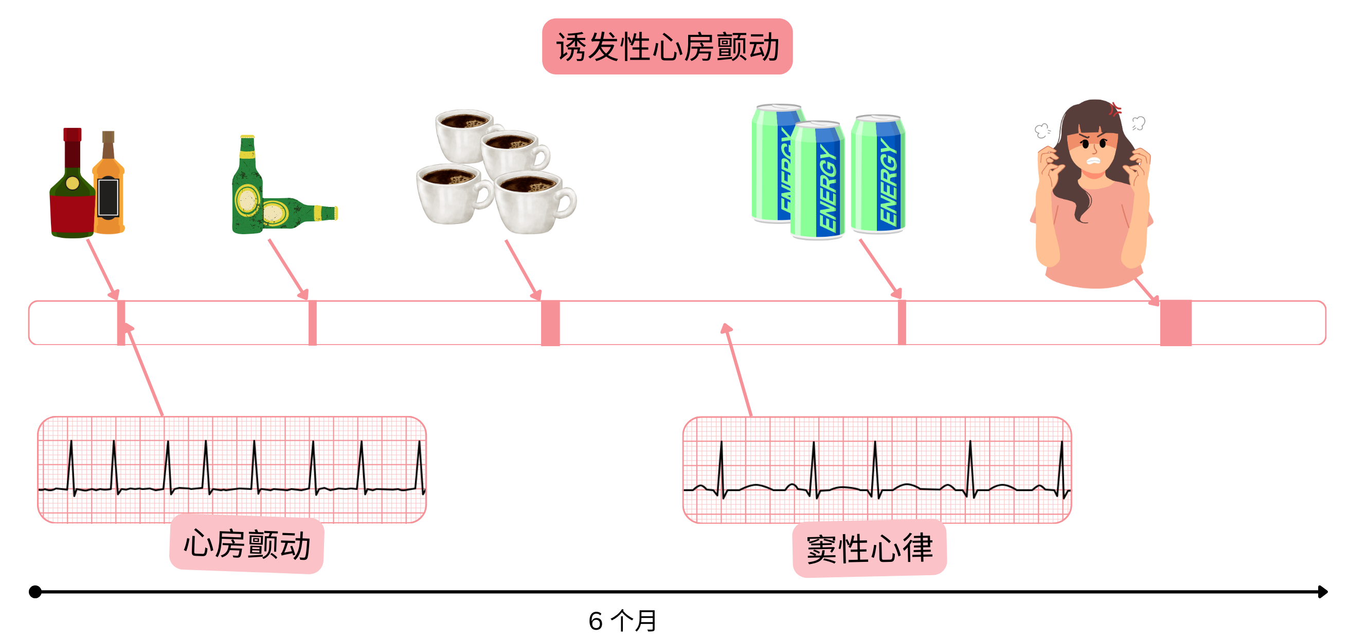 信息图展示由酒精、咖啡因、能量饮料和情绪压力诱发的心房颤动，以及心房颤动与窦性心律随时间相互转换的过程。