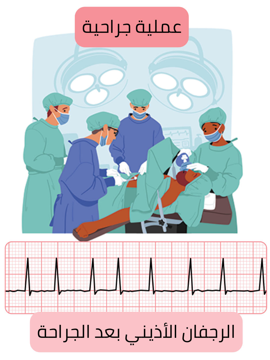 رسم توضيحي للرجفان الأذيني التالي للجراحة بعد إجراء جراحي مع توثيق اضطراب النظم بتخطيط القلب.