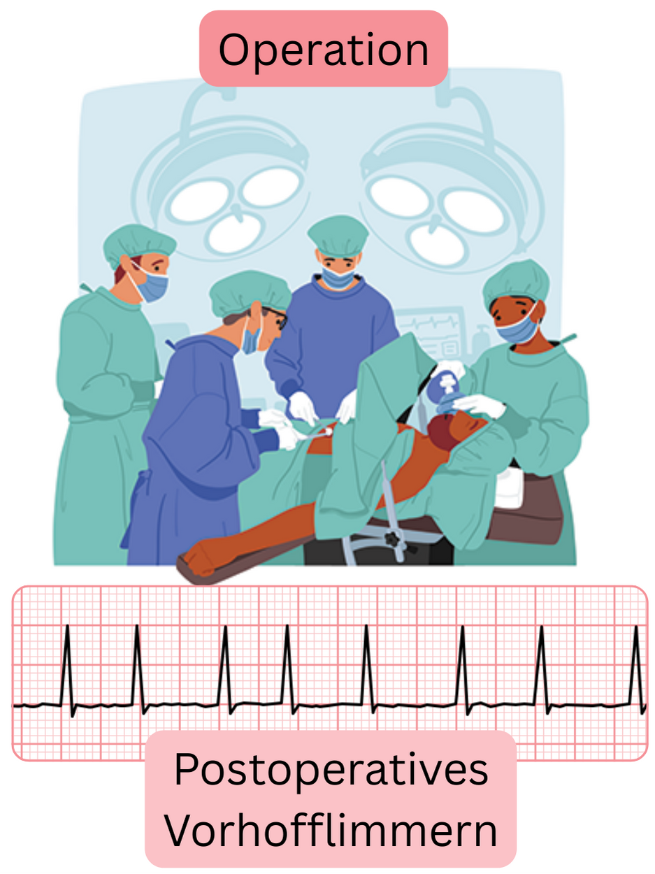 Illustration eines postoperativen Vorhofflimmerns nach einem chirurgischen Eingriff mit dokumentiertem EKG-Nachweis der Arrhythmie.