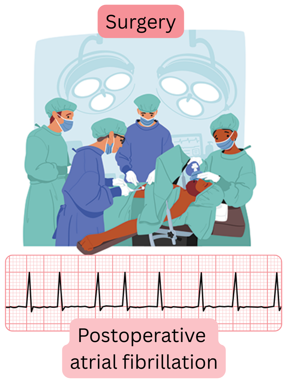 Illustration of postoperative atrial fibrillation occurring after surgical intervention with documented ECG evidence of arrhythmia.