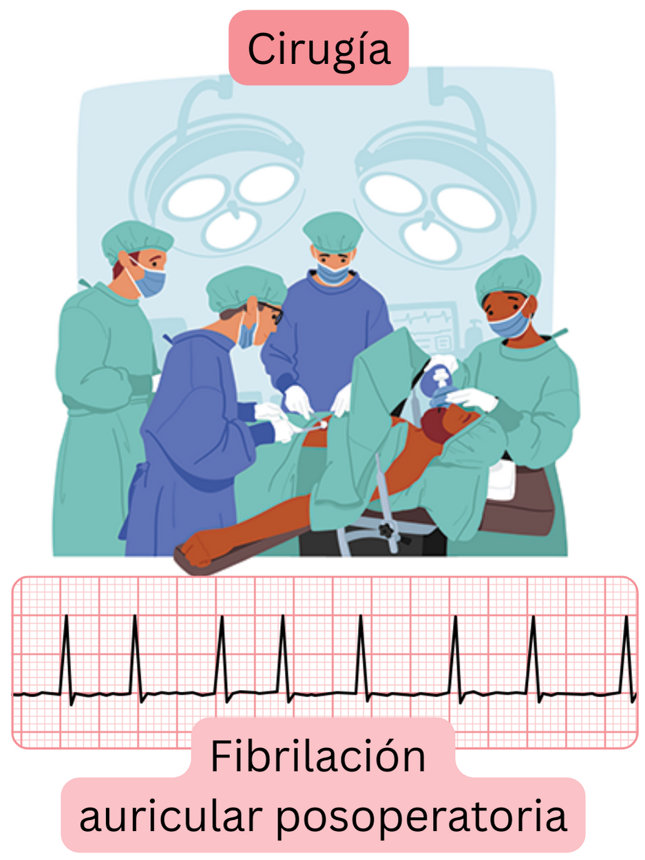 Ilustración de la fibrilación auricular posoperatoria que aparece tras una intervención quirúrgica con registro ECG documentado de la arritmia.