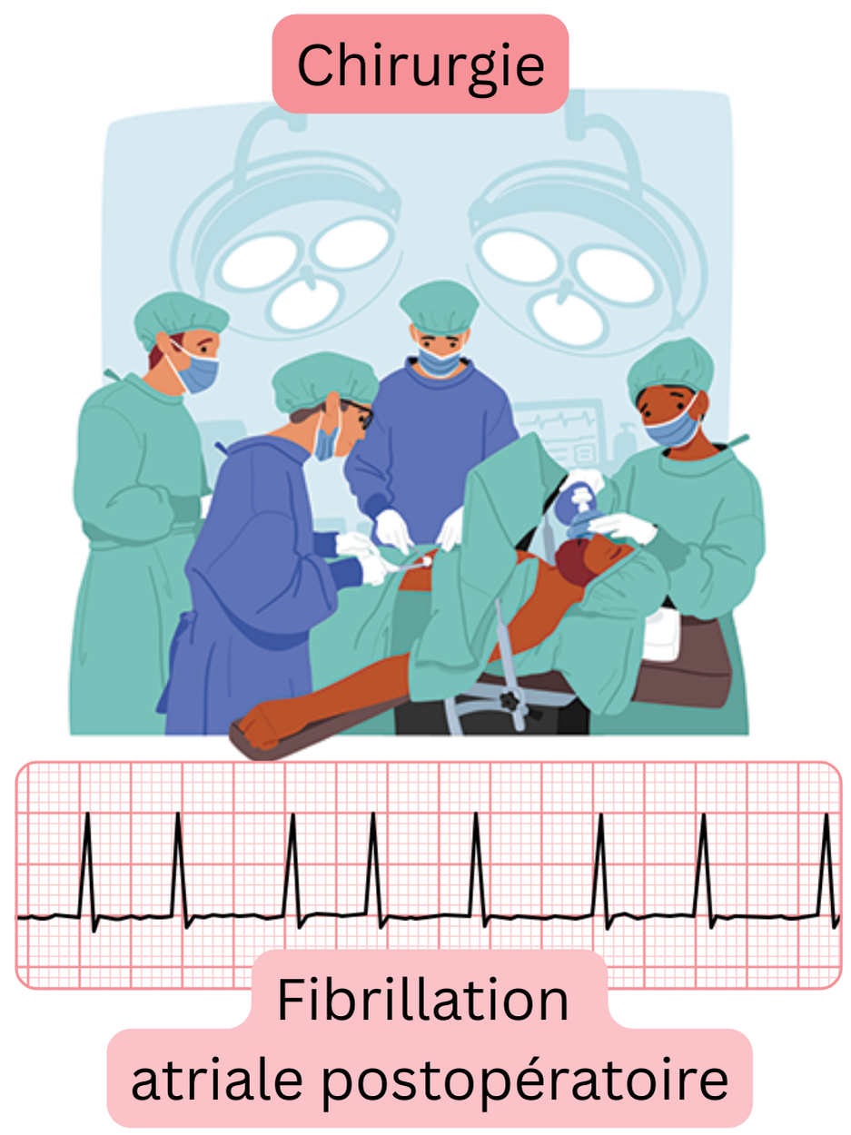 Illustration d’une fibrillation atriale postopératoire survenant après une intervention chirurgicale avec un tracé ECG documenté de l’arythmie.