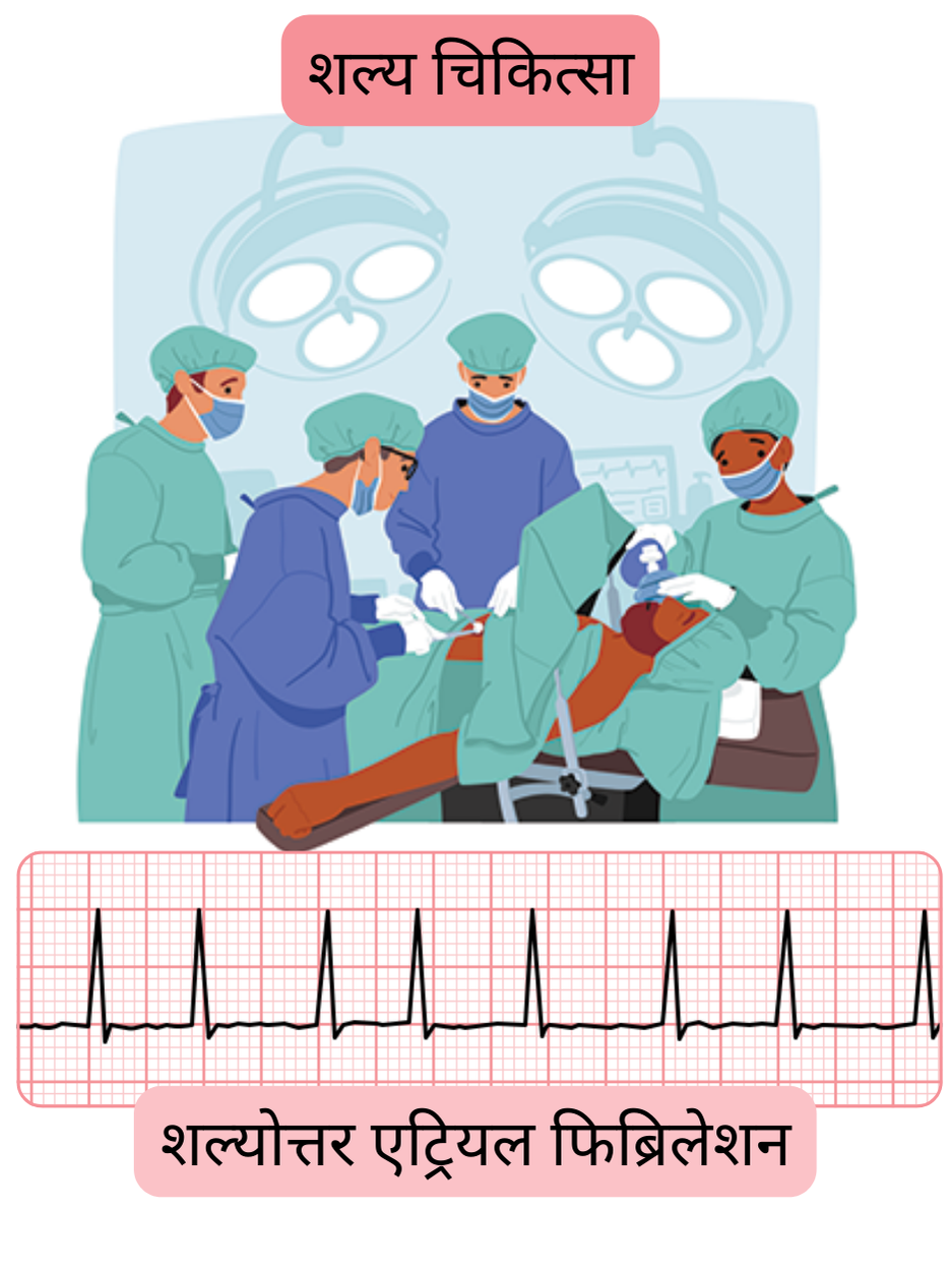यह चित्र शल्य प्रक्रिया के बाद उत्पन्न होने वाले पोस्टऑपरेटिव एट्रियल फिब्रिलेशन को दर्शाता है, जिसमें अतालता का प्रलेखित ईसीजी प्रमाण शामिल है।