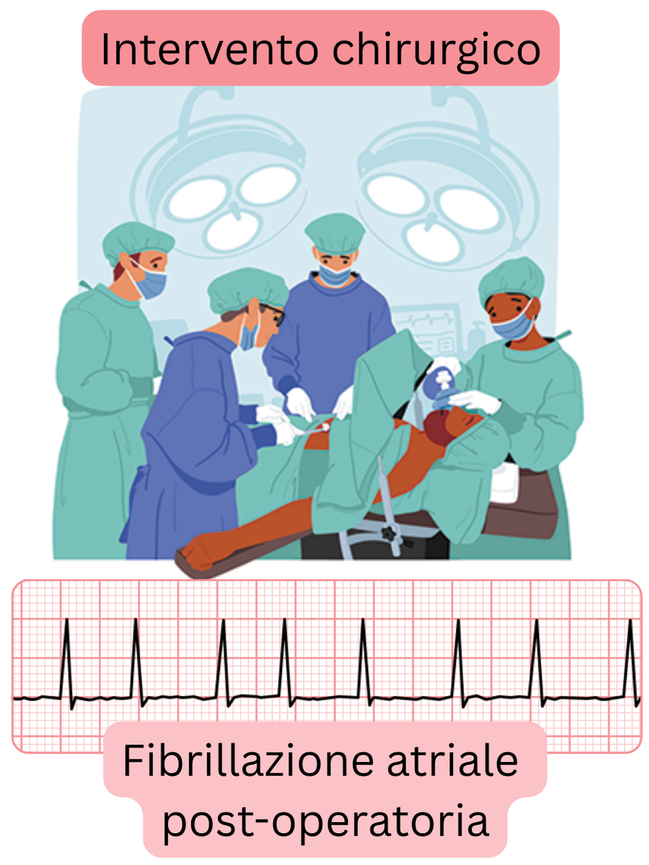 Illustrazione della fibrillazione atriale postoperatoria insorta dopo un intervento chirurgico con documentazione ECG dell’aritmia.