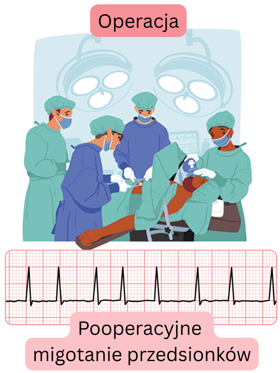 Ilustracja pooperacyjnego migotania przedsionków występującego po zabiegu chirurgicznym z udokumentowanym zapisem EKG arytmii.