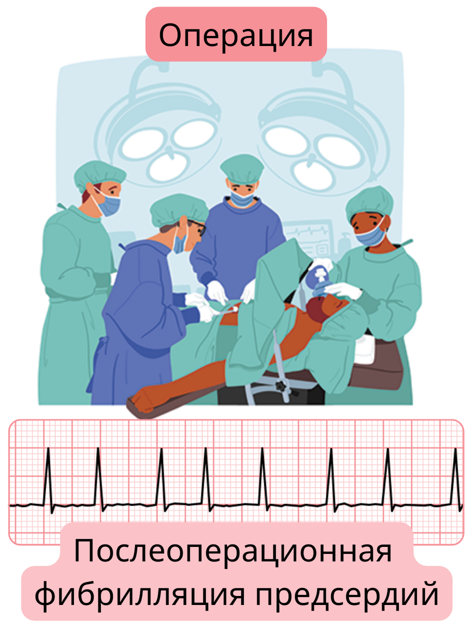 Иллюстрация послеоперационной фибрилляции предсердий, возникшей после хирургического вмешательства, с документированным ЭКГ-записем аритмии.