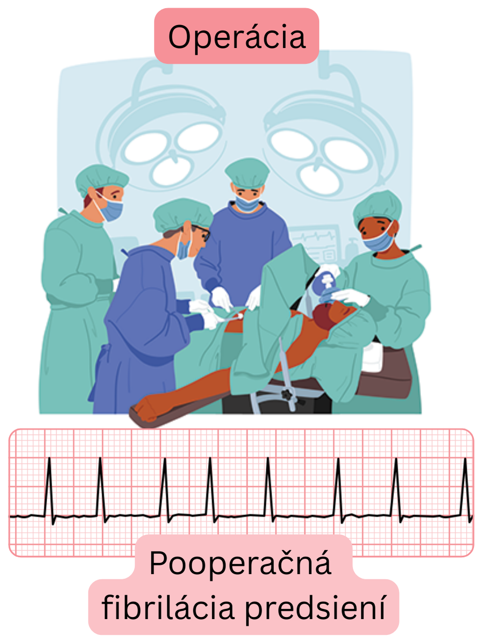 Ilustrácia pooperačnej fibrilácie predsiení vznikajúcej po chirurgickom výkone s dokumentovaným EKG záznamom arytmie.