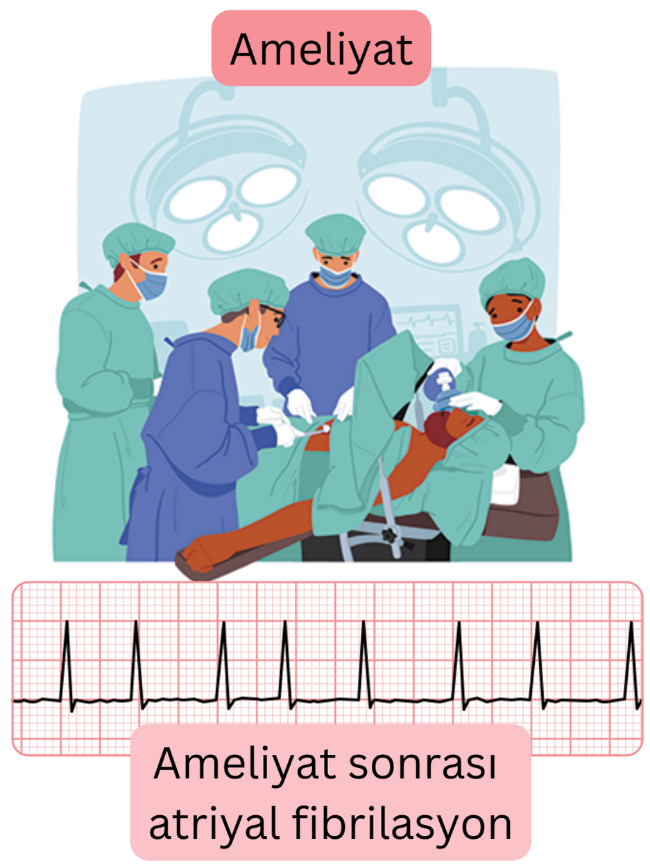 Cerrahi girişim sonrası gelişen postoperatif atriyal fibrilasyonu ve aritminin EKG ile belgelenmesini gösteren ilustrasyon.