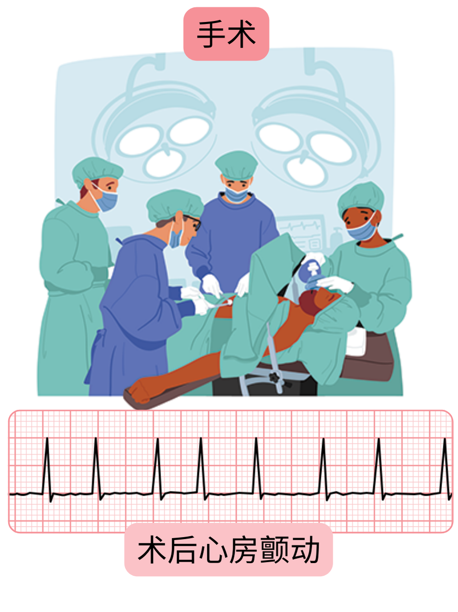 示意图展示术后发生的心房颤动，并有明确的心电图记录证实心律失常。