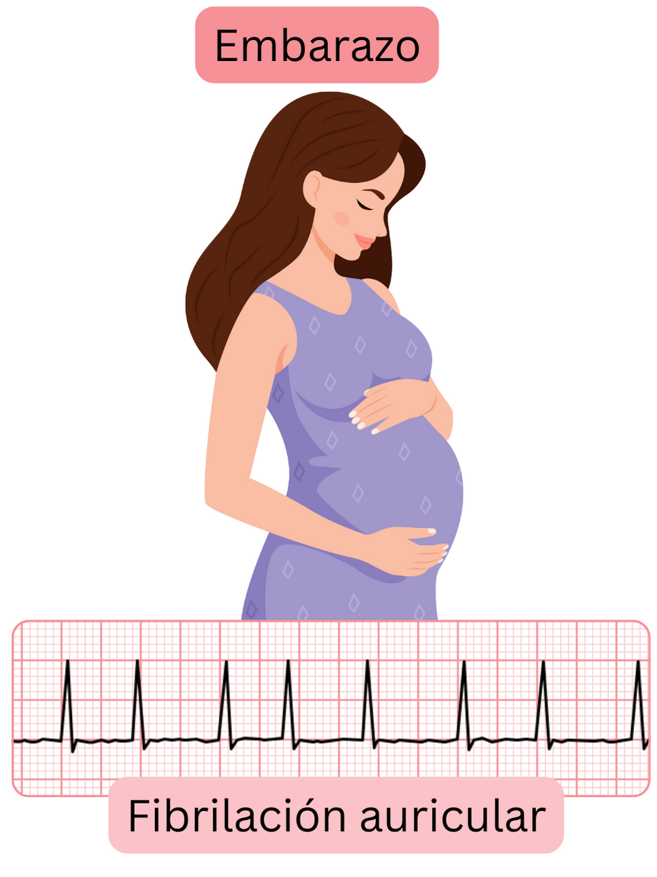 Ilustración de la fibrilación auricular en una mujer embarazada con registro ECG documentado de la arritmia durante la gestación.