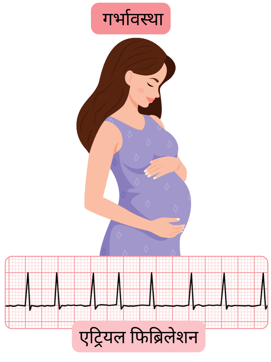 यह चित्र गर्भावस्था के दौरान गर्भवती महिला में एट्रियल फिब्रिलेशन को दर्शाता है, जिसमें अतालता का प्रलेखित ईसीजी प्रमाण शामिल है।