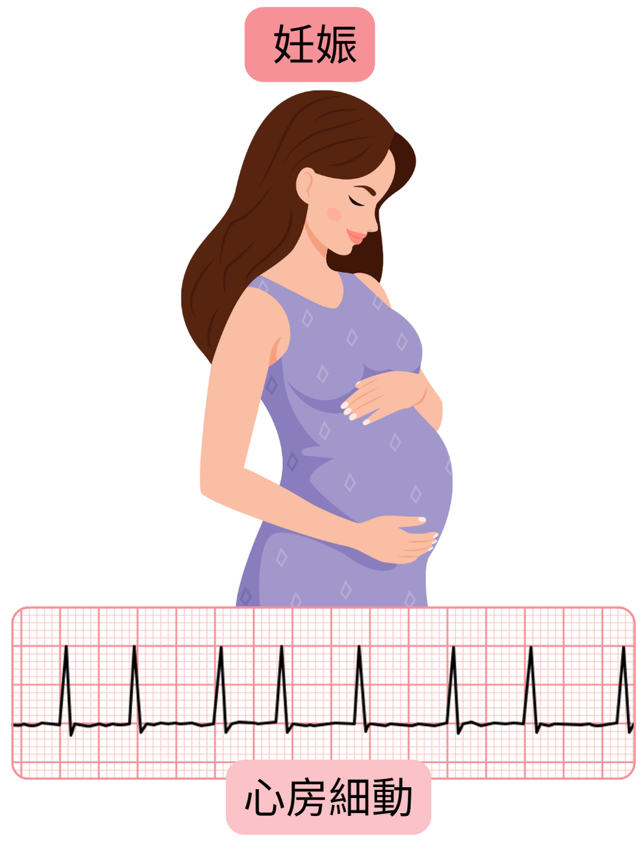 妊娠中に発生した心房細動を示し、不整脈が心電図で確認された妊婦のイラスト。