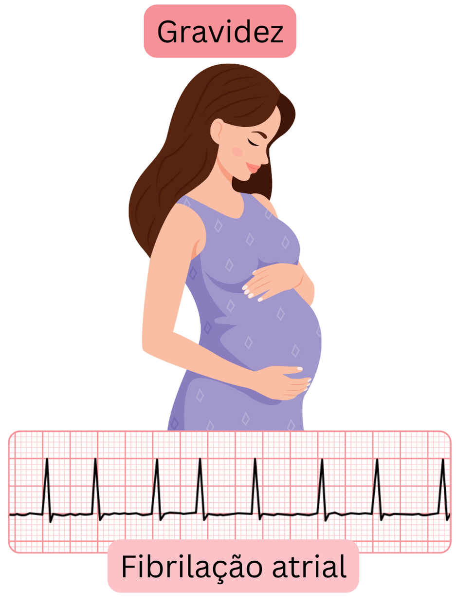 Ilustração da fibrilação atrial em mulher grávida com registo ECG documentado da arritmia durante a gravidez.