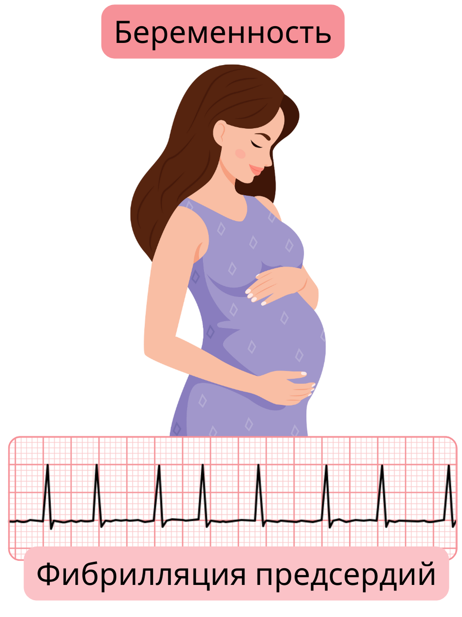 Иллюстрация фибрилляции предсердий у беременной женщины с документированным ЭКГ-записем аритмии во время беременности.