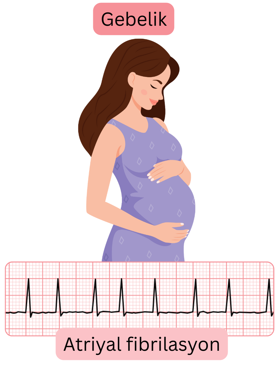 Gebelik sırasında EKG ile belgelenmiş aritmi kaydı bulunan hamile kadında atriyal fibrilasyonu gösteren ilustrasyon.