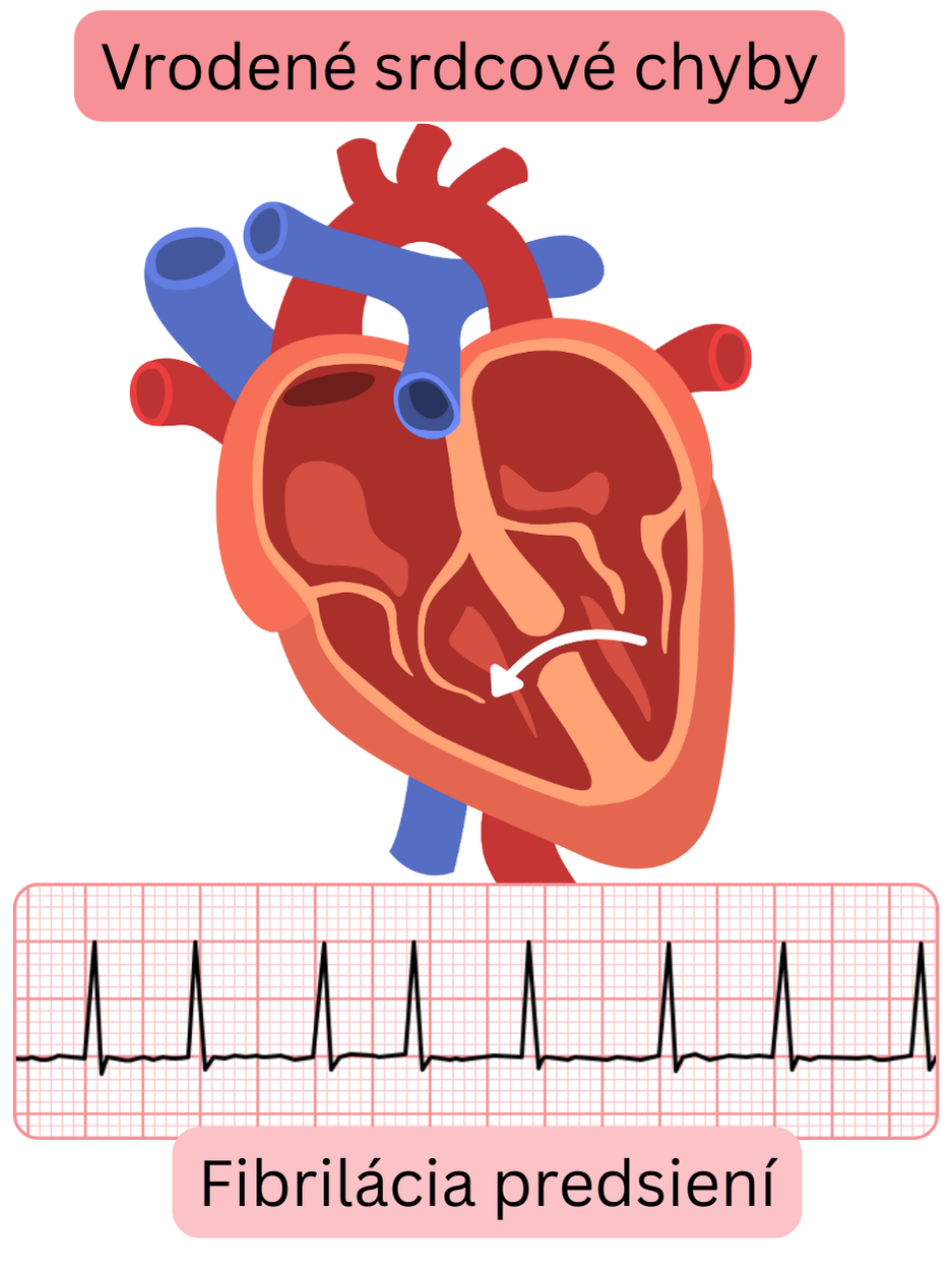 Ilustrácia fibrilácie predsiení u pacienta s vrodenou srdcovou chybou so schematickým zobrazením štrukturálnej abnormality srdca a EKG záznamom arytmie.