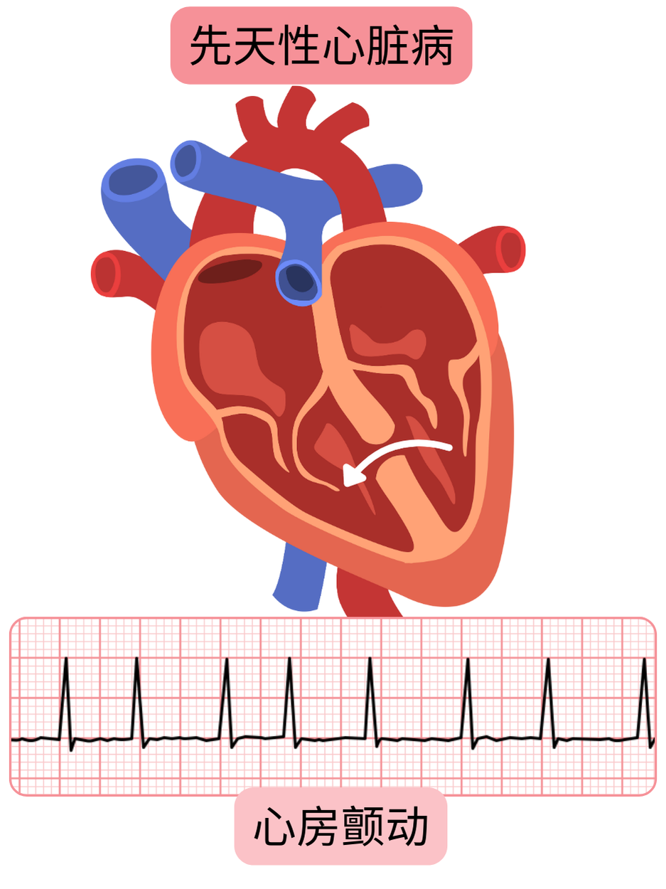 示意图展示先天性心脏病患者发生心房颤动，包含心脏结构异常的示意图及心律失常的心电图记录。