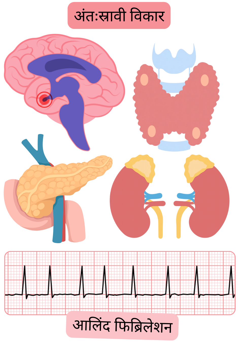 चित्र में पिट्यूटरी ग्रंथि, थायरॉयड ग्रंथि, अग्न्याशय और अधिवृक्क ग्रंथियों के विकारों सहित एंडोक्रिनोपैथी को एट्रियल फिब्रिलेशन के जोखिम कारकों के रूप में दर्शाया गया है, साथ में ईसीजी पर अतालता का रिकॉर्ड।