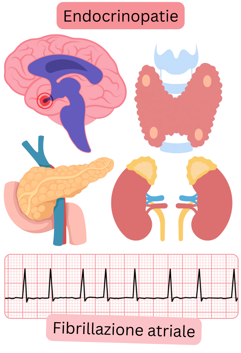 Illustrazione che mostra le endocrinopatie, inclusi i disturbi dell’ipofisi, della tiroide, del pancreas e delle ghiandole surrenali, come fattori di rischio della fibrillazione atriale con documentazione ECG dell’aritmia.