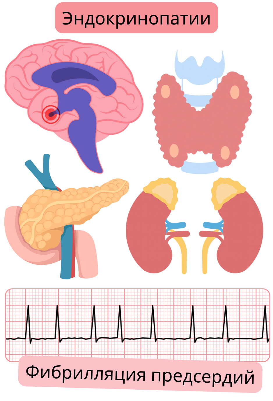 Иллюстрация, демонстрирующая эндокринопатии, включая заболевания гипофиза, щитовидной железы, поджелудочной железы и надпочечников, как факторы риска фибрилляции предсердий с ЭКГ-документацией аритмии.