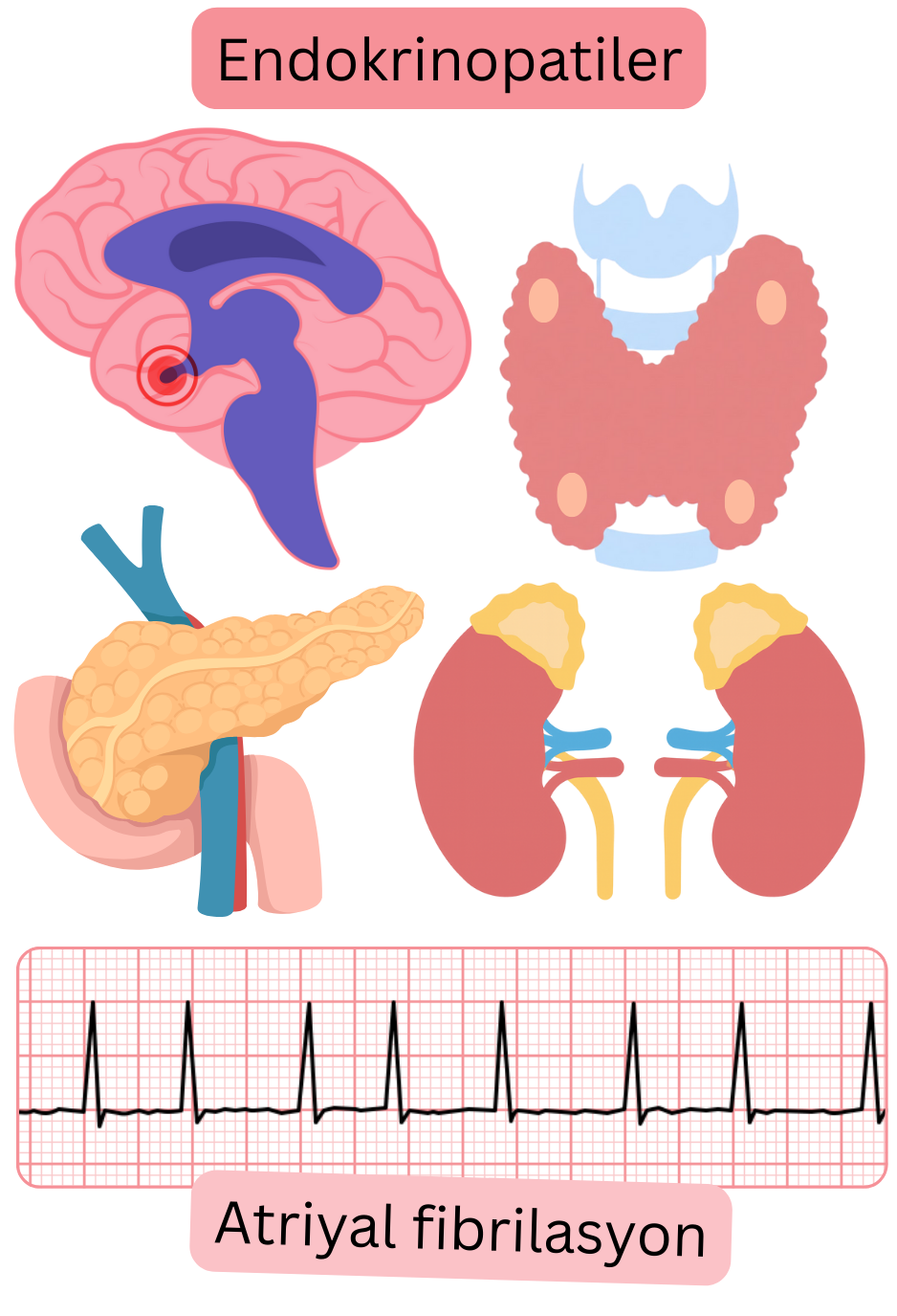Hipofiz, tiroid, pankreas ve adrenal bez bozuklukları dahil endokrinopatileri atriyal fibrilasyon için risk faktörleri olarak ve aritminin EKG kaydı ile gösteren illüstrasyon.