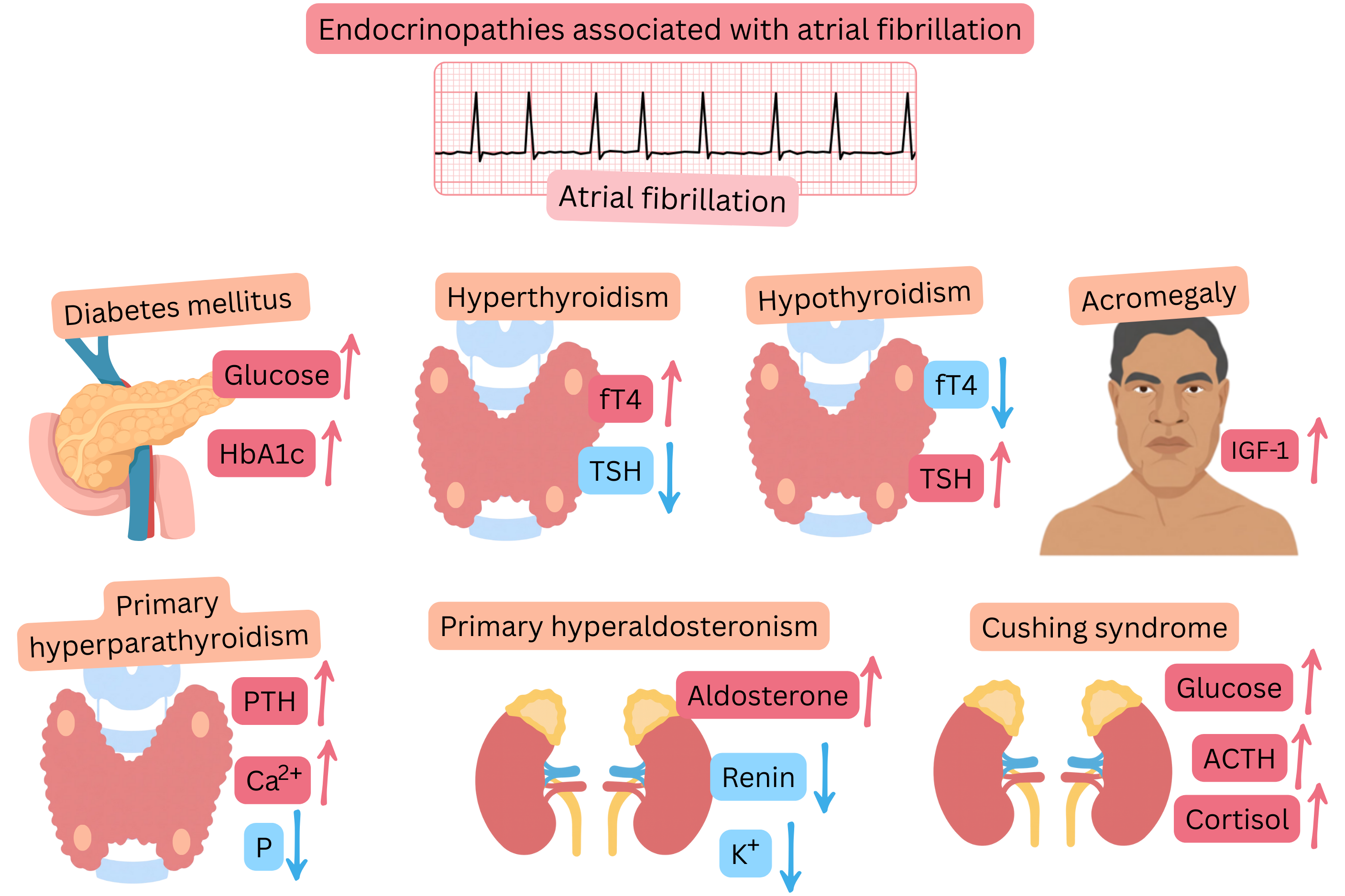 Infographic illustrating endocrinopathies associated with atrial fibrillation, including diabetes mellitus, hyperthyroidism, hypothyroidism, acromegaly, primary hyperparathyroidism, primary hyperaldosteronism, and Cushing syndrome, with characteristic hormonal and metabolic changes and ECG documentation of atrial fibrillation.
