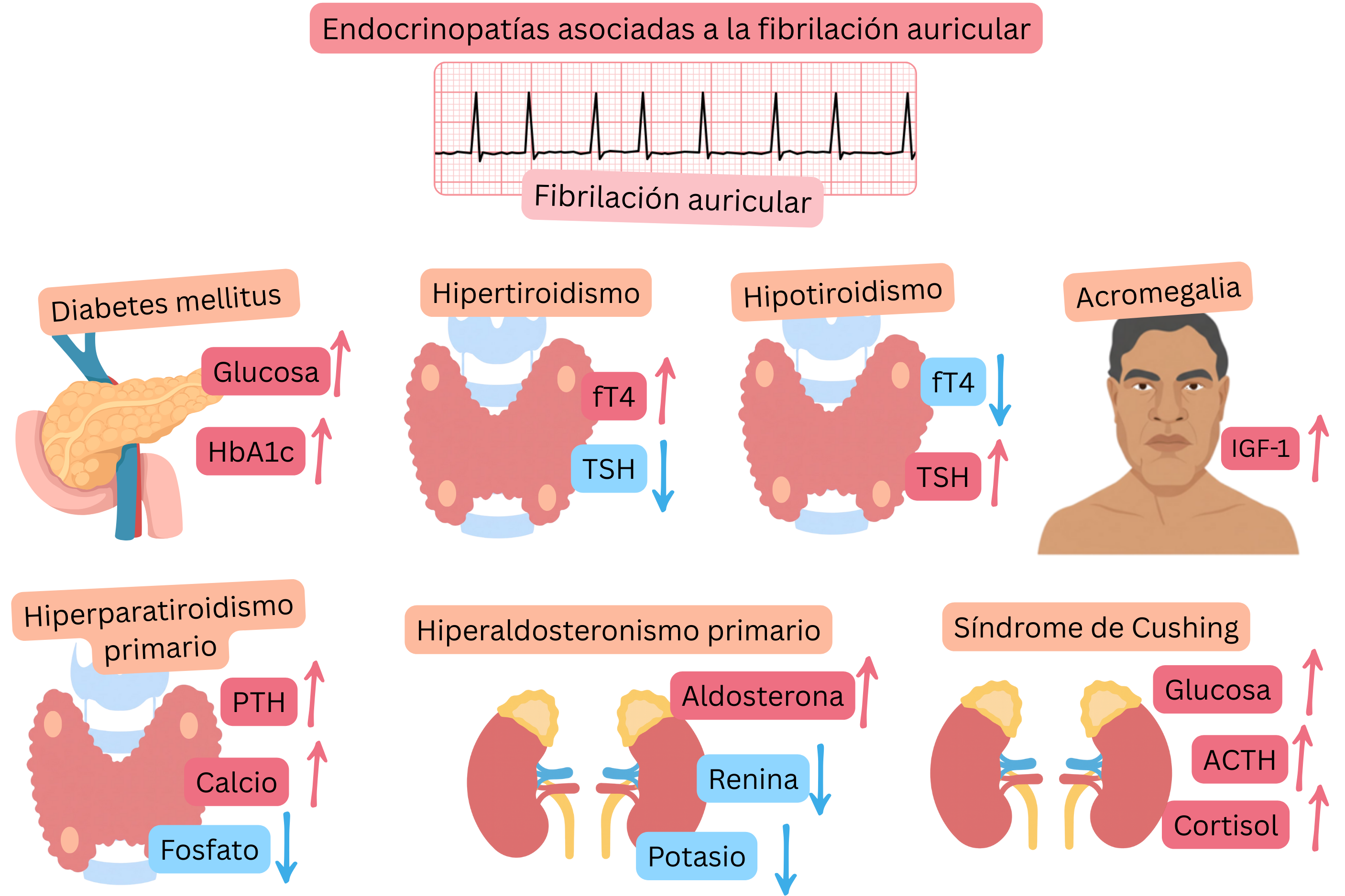 Infografía que muestra las endocrinopatías asociadas a la fibrilación auricular, incluyendo diabetes mellitus, hipertiroidismo, hipotiroidismo, acromegalia, hiperparatiroidismo primario, hiperaldosteronismo primario y síndrome de Cushing, con cambios hormonales y metabólicos característicos y registro ECG de fibrilación auricular.