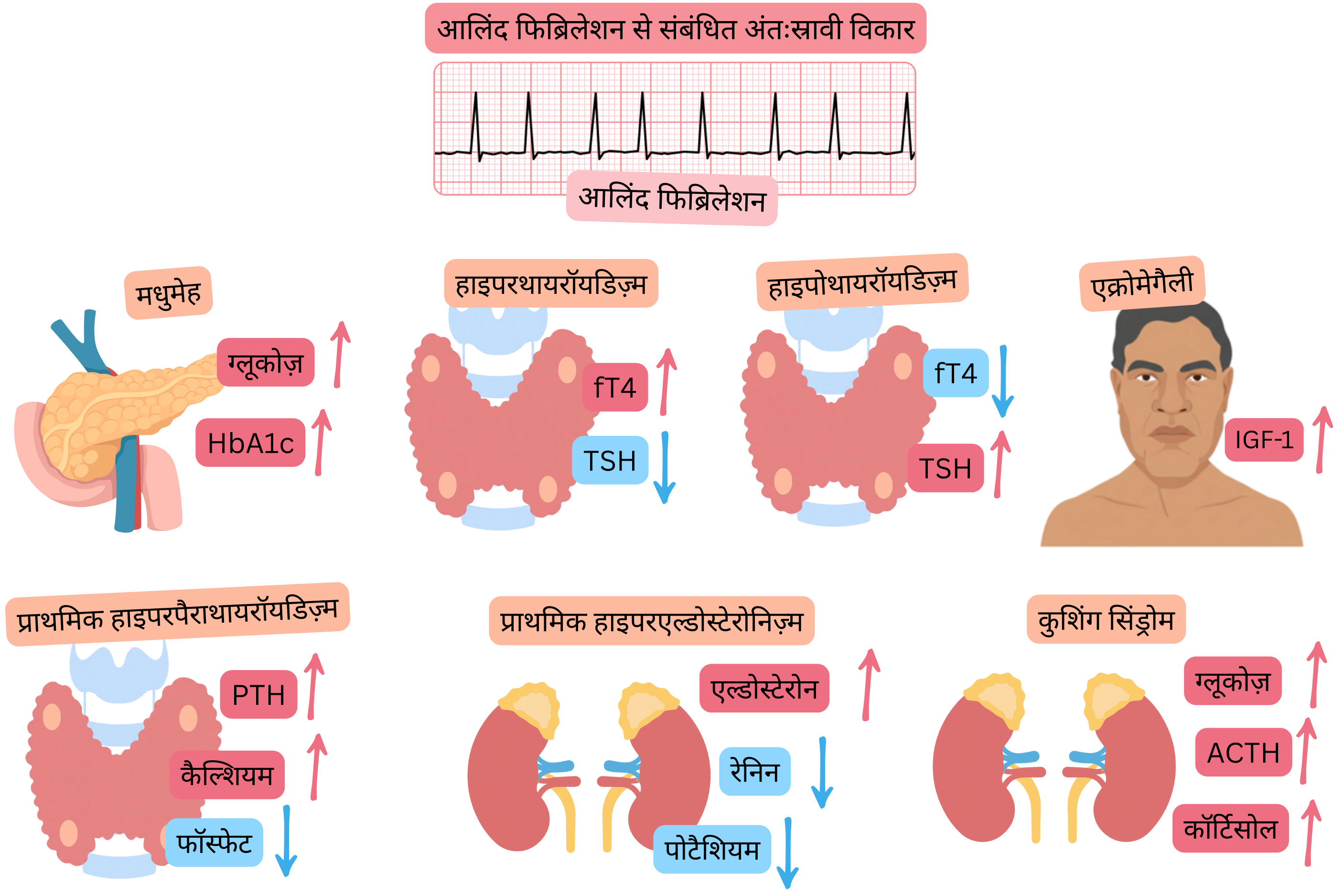 इन्फोग्राफिक में एट्रियल फिब्रिलेशन से संबंधित एंडोक्रिनोपैथियों को दर्शाया गया है, जिनमें मधुमेह मेलिटस, हाइपरथायरॉयडिज़्म, हाइपोथायरॉयडिज़्म, एक्रोमेगली, प्राथमिक हाइपरपैराथायरॉयडिज़्म, प्राथमिक हाइपरएल्डोस्टेरोनिज़्म और कुशिंग सिंड्रोम शामिल हैं, साथ ही विशिष्ट हार्मोनल व चयापचय परिवर्तन और ईसीजी पर एट्रियल फिब्रिलेशन का रिकॉर्ड।