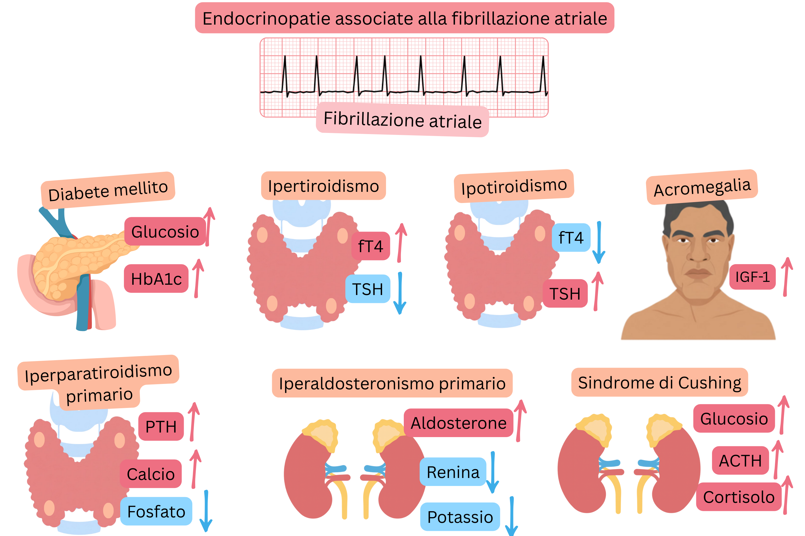 Infografica che illustra le endocrinopatie associate alla fibrillazione atriale, incluse diabete mellito, ipertiroidismo, ipotiroidismo, acromegalia, iperparatiroidismo primario, iperaldosteronismo primario e sindrome di Cushing, con tipiche alterazioni ormonali e metaboliche e documentazione ECG della fibrillazione atriale.