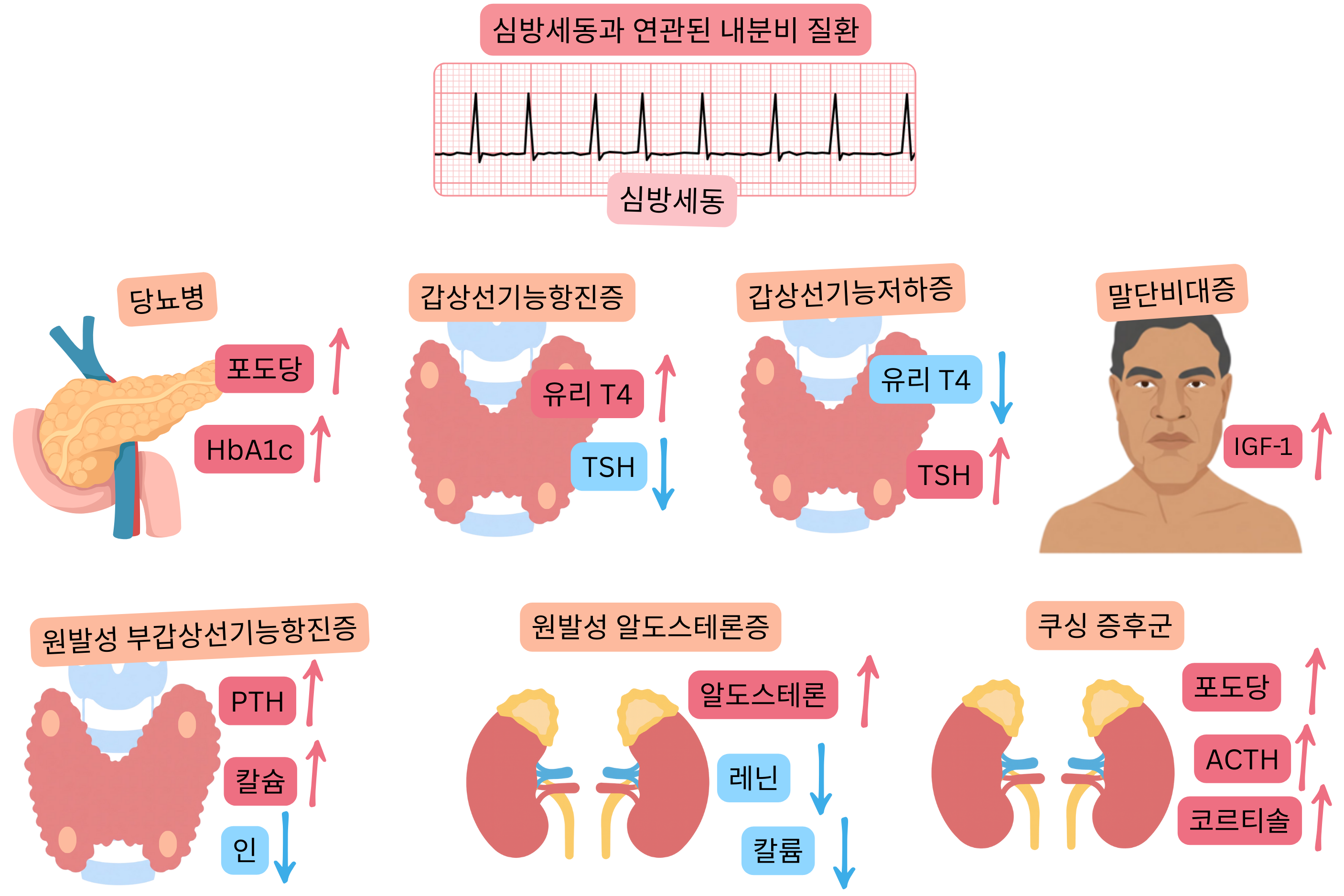 당뇨병, 갑상선기능항진증, 갑상선기능저하증, 말단비대증, 원발성 부갑상선기능항진증, 원발성 고알도스테론증 및 쿠싱증후군 등 심방세동과 연관된 내분비 질환을 특징적인 호르몬·대사 변화와 심방세동의 심전도 소견과 함께 제시한 인포그래픽.