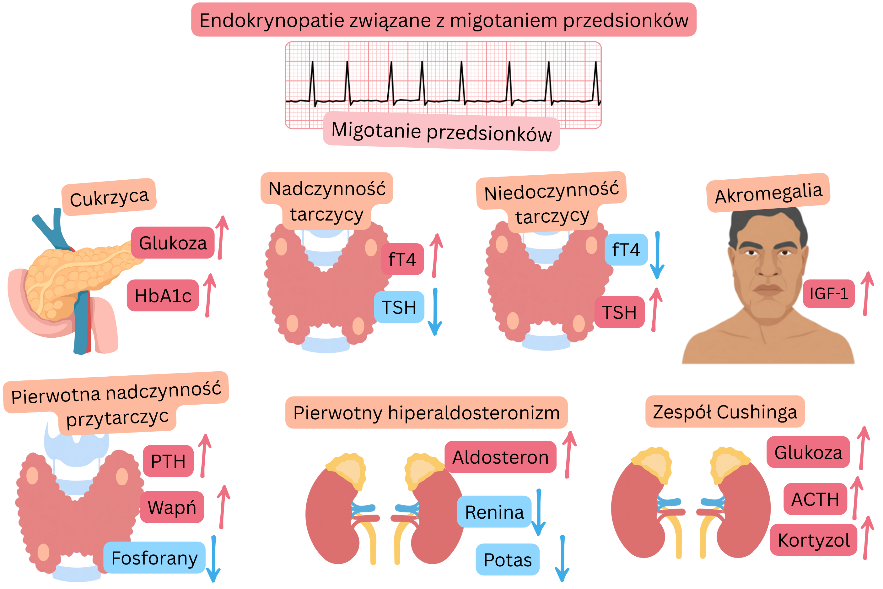 Infografika przedstawiająca endokrynopatie związane z migotaniem przedsionków, w tym cukrzycę, nadczynność tarczycy, niedoczynność tarczycy, akromegalię, pierwotną nadczynność przytarczyc, pierwotny hiperaldosteronizm oraz zespół Cushinga, z typowymi zmianami hormonalnymi i metabolicznymi oraz zapisem EKG migotania przedsionków.